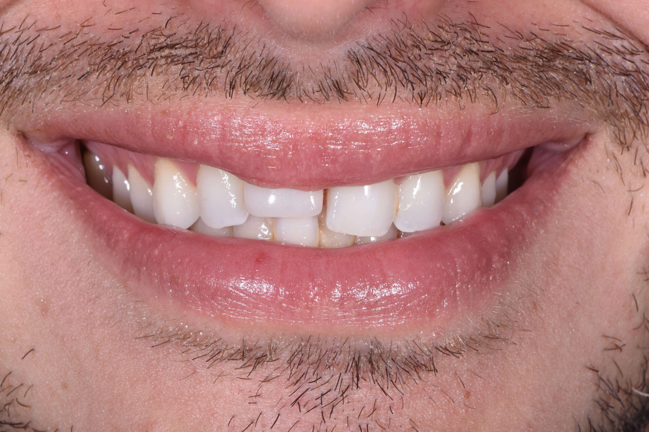 Teeth Whitening — before