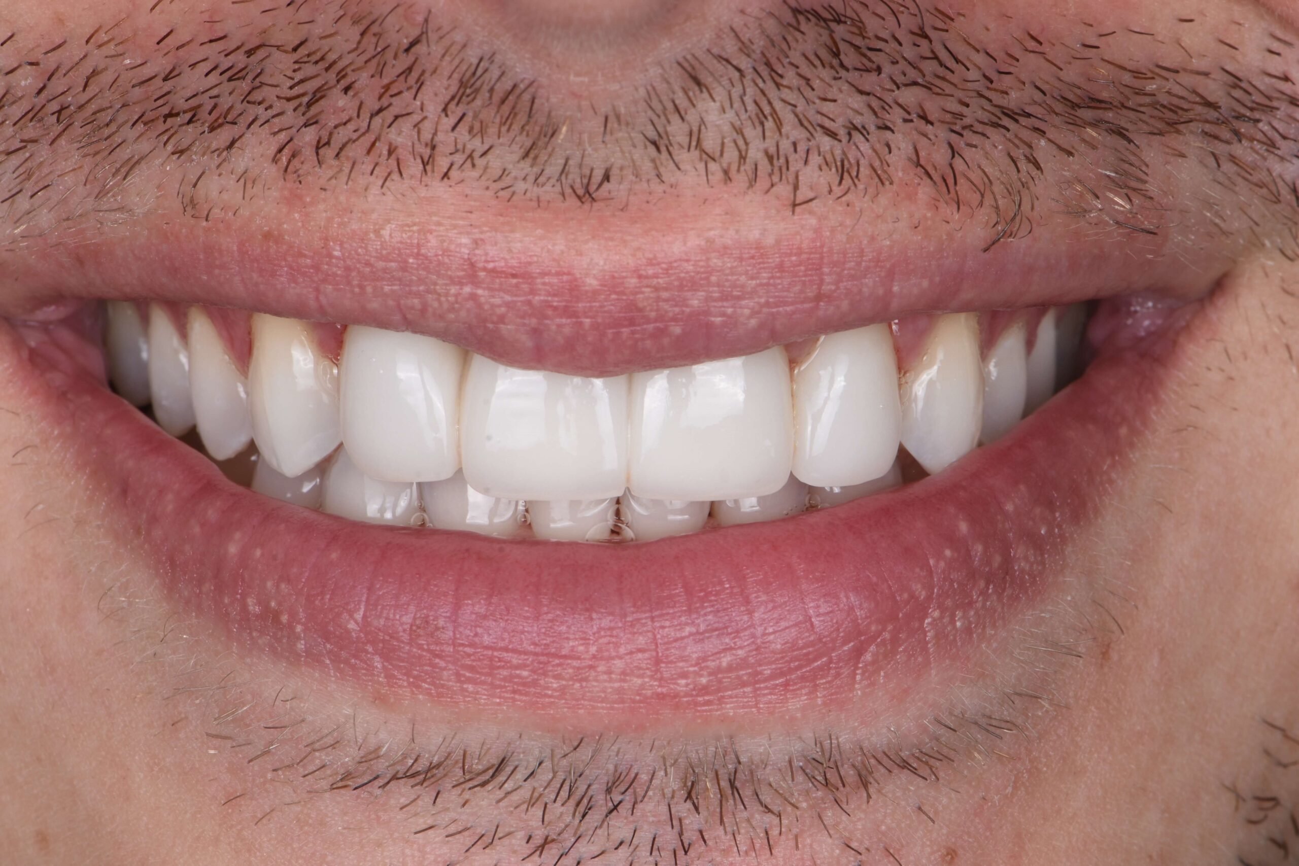 Teeth Whitening — after