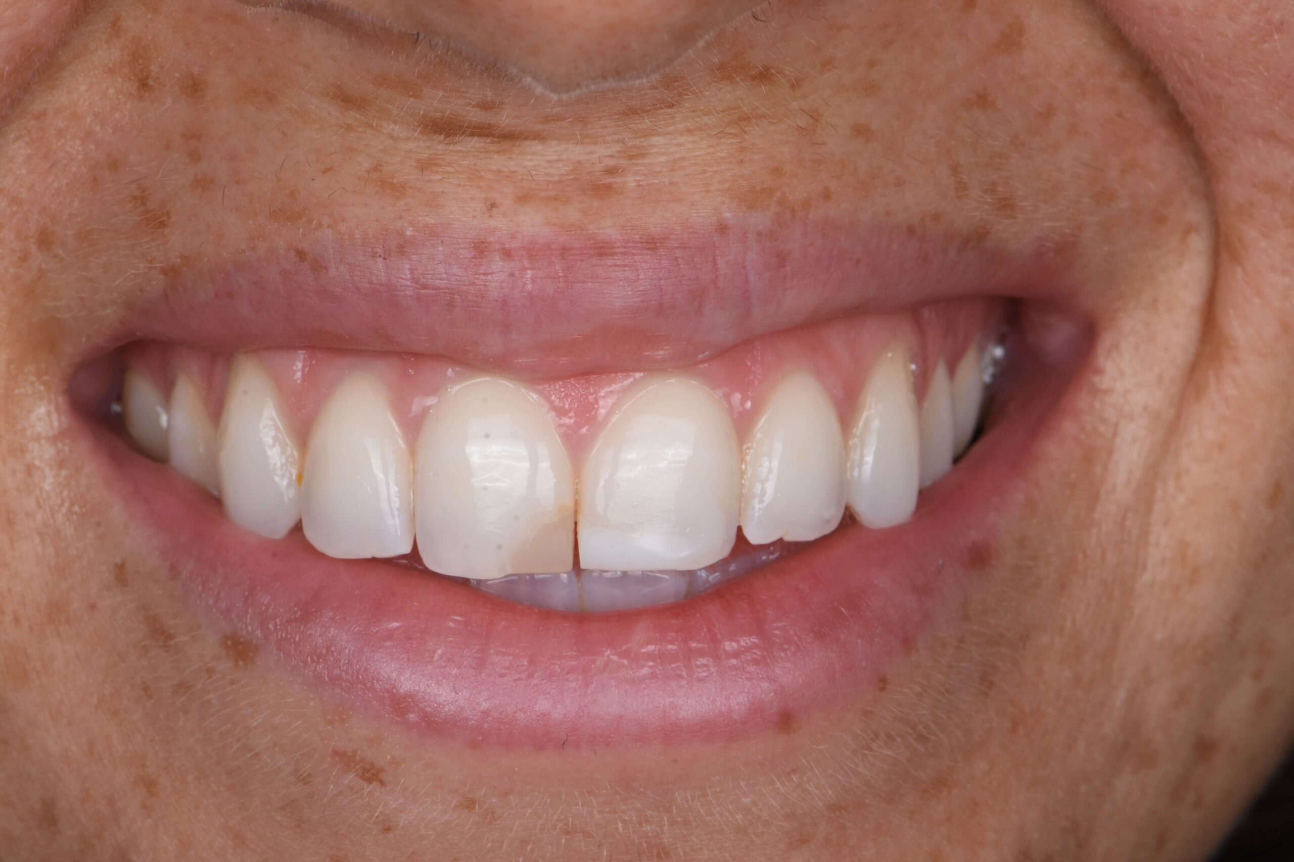 Teeth Whitening — before
