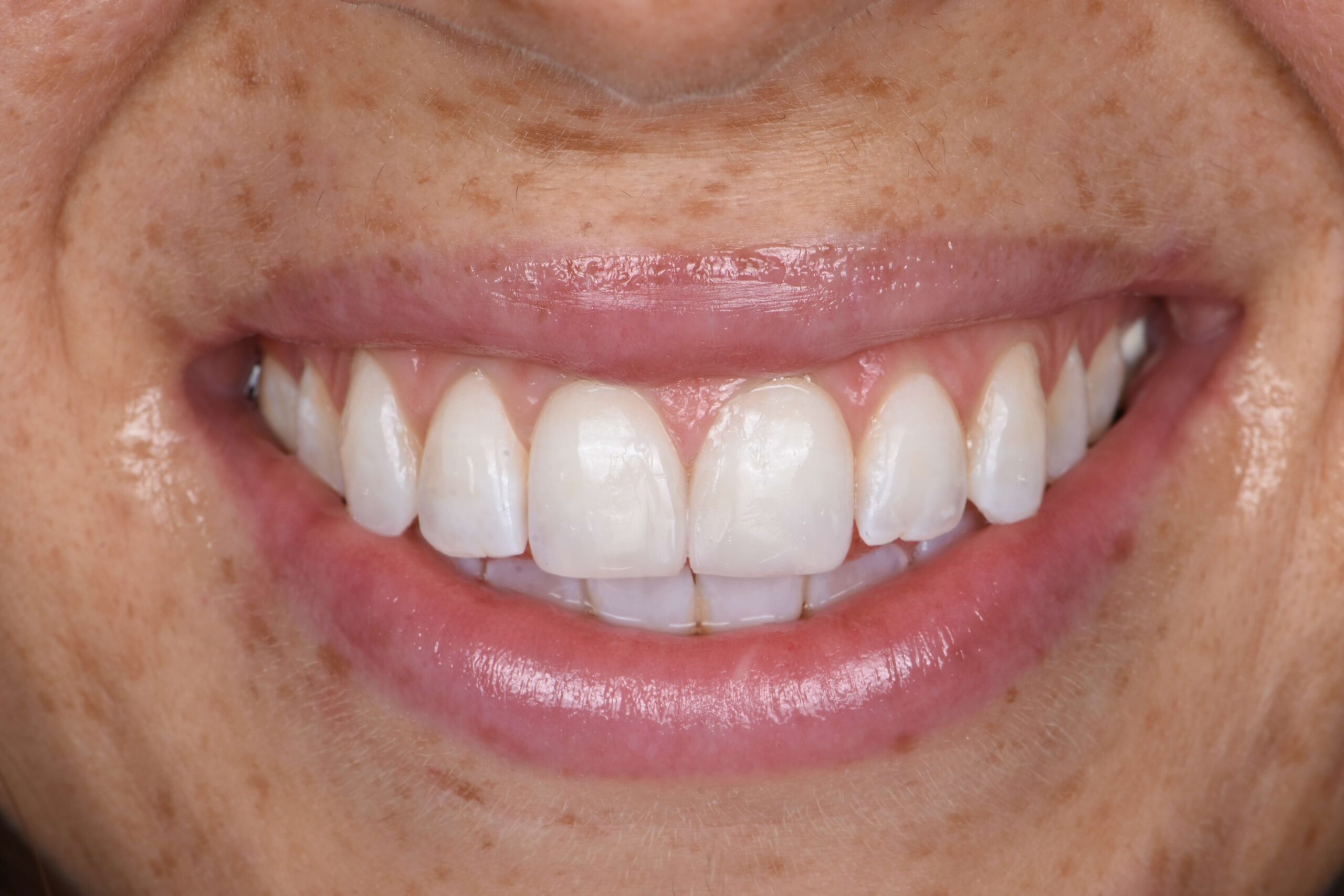 Teeth Whitening — after
