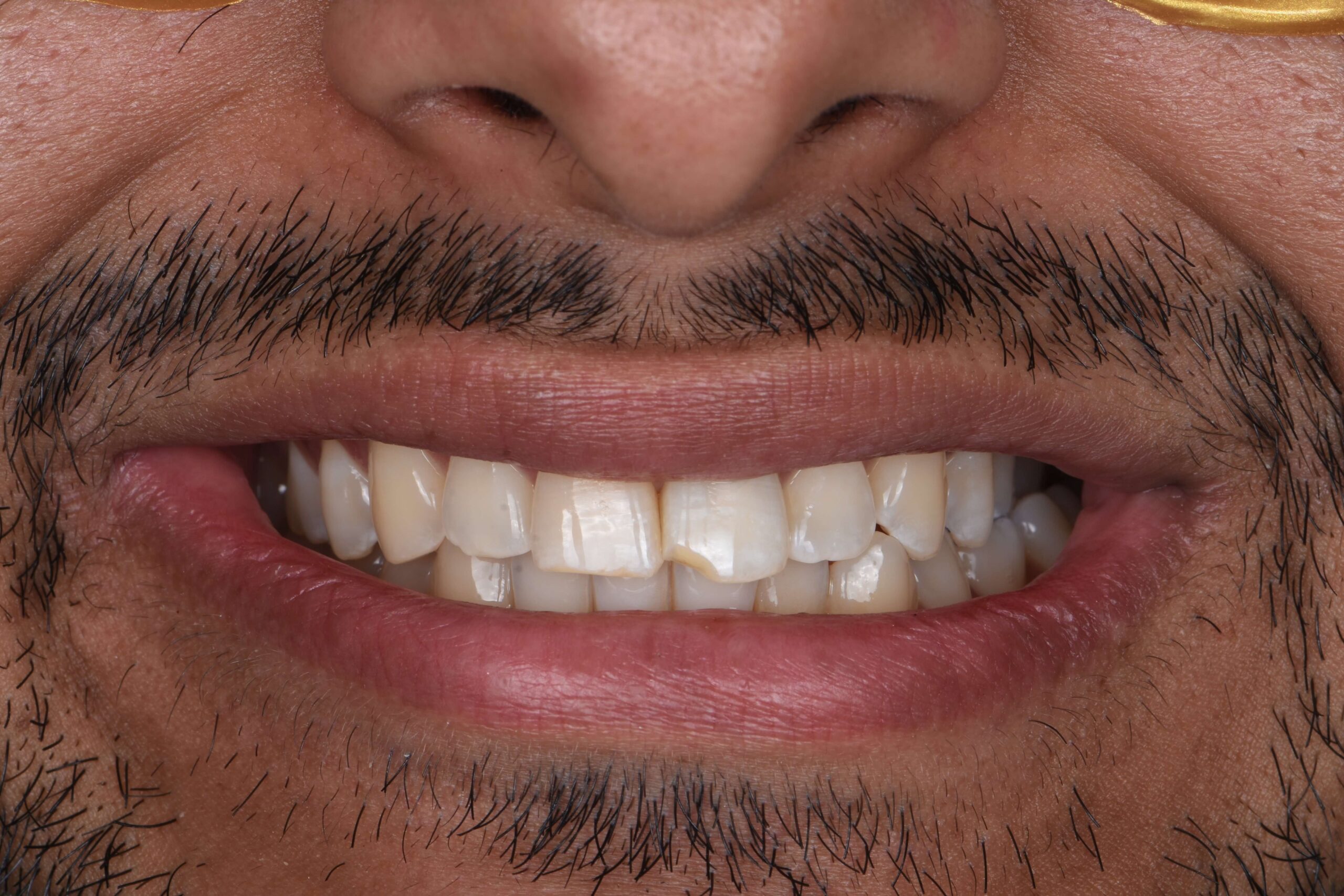 Tooth-Colored Fillings — before