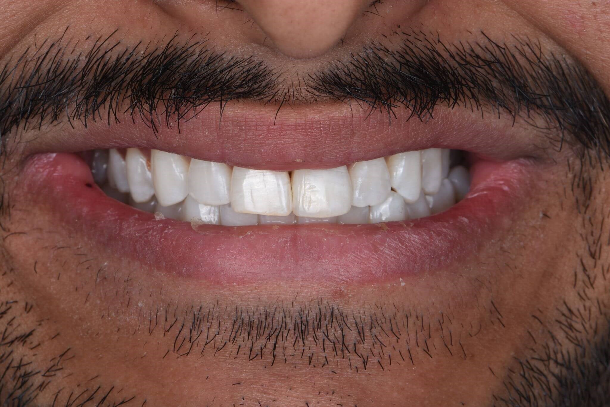 Tooth-Colored Fillings — after
