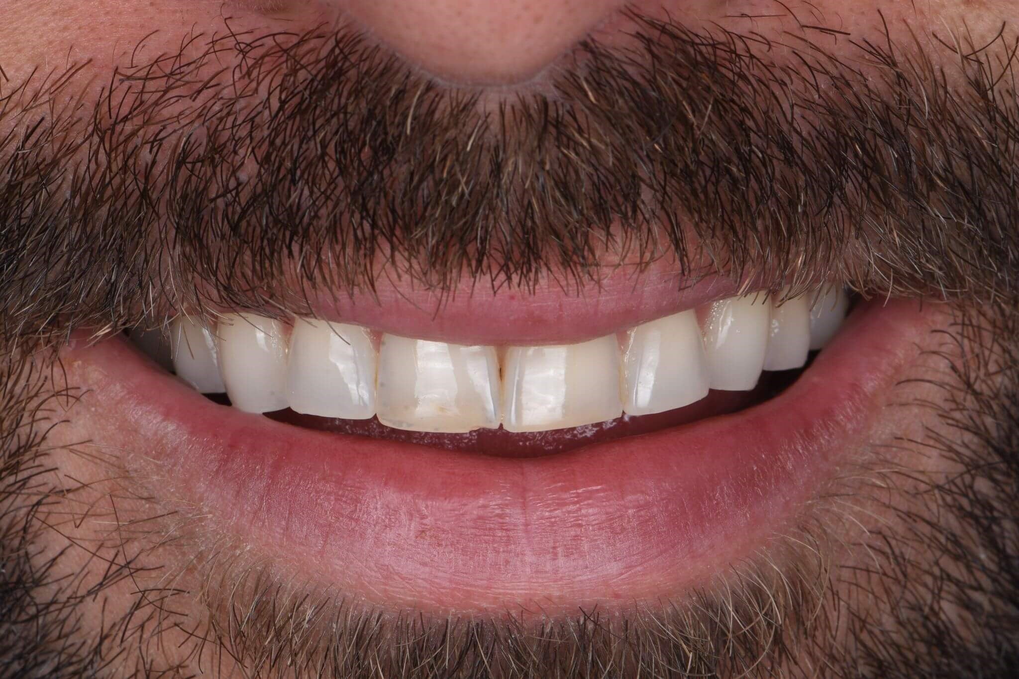 Composite Veneers — before