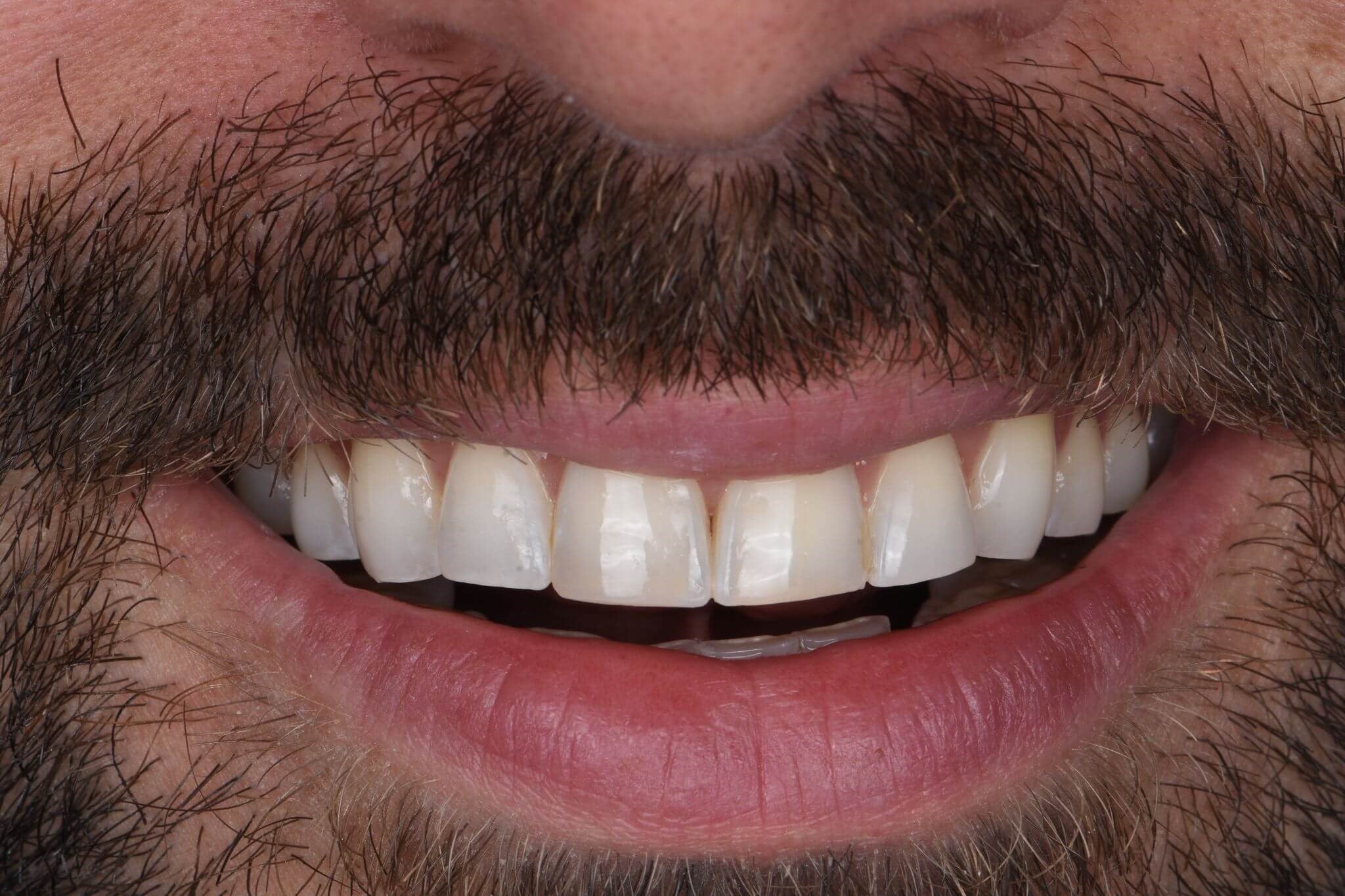 Composite Veneers — after