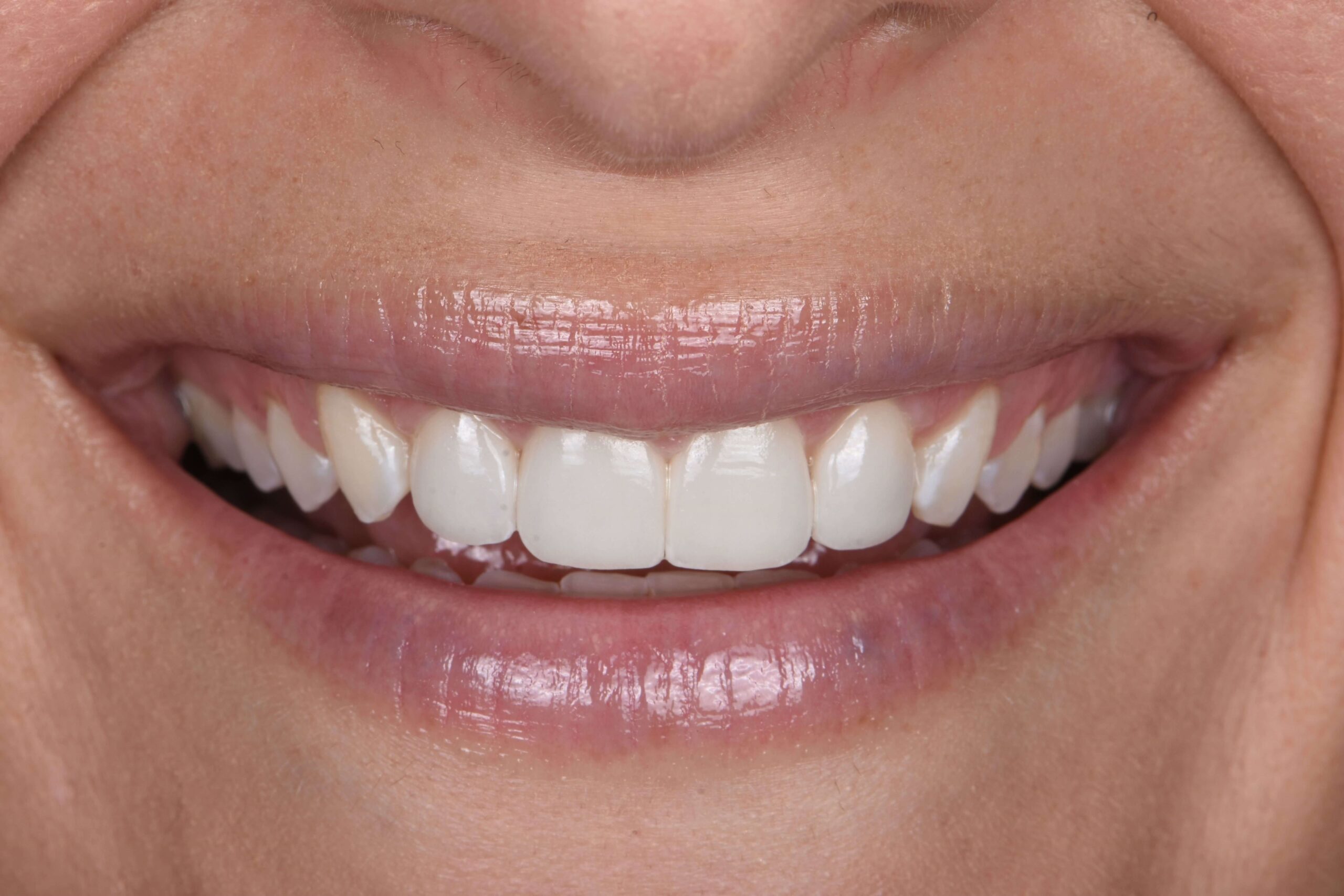 KöR® Whitening — after