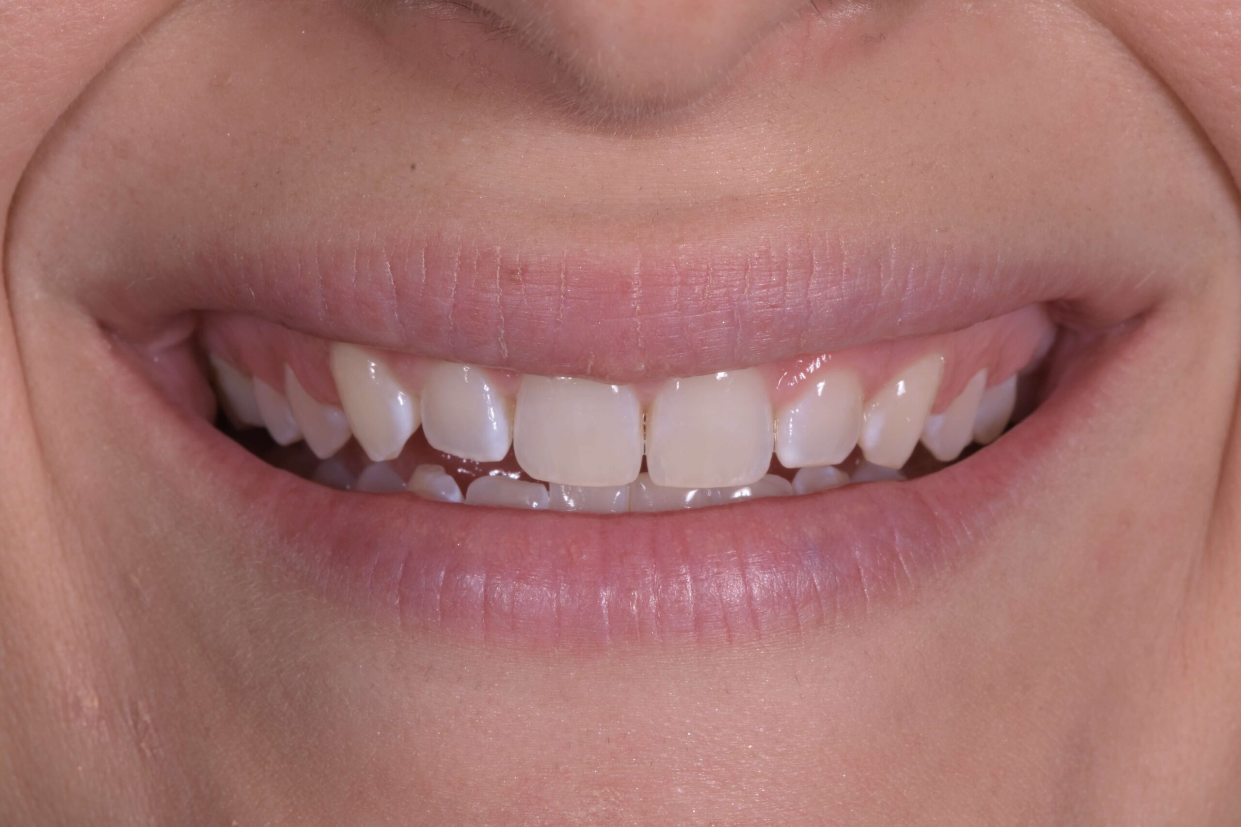 KöR® Whitening — before