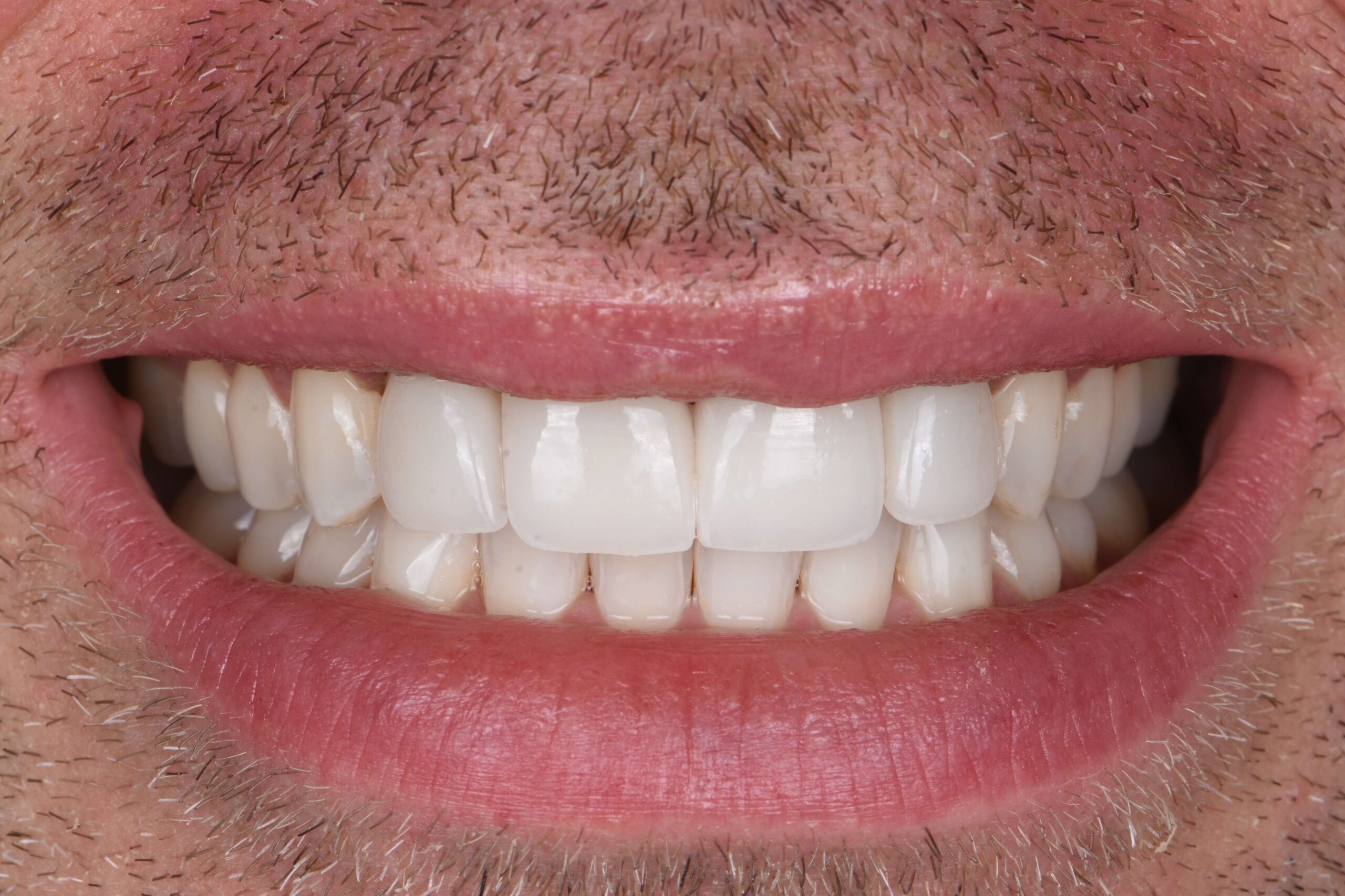 Dental Crowns — after
