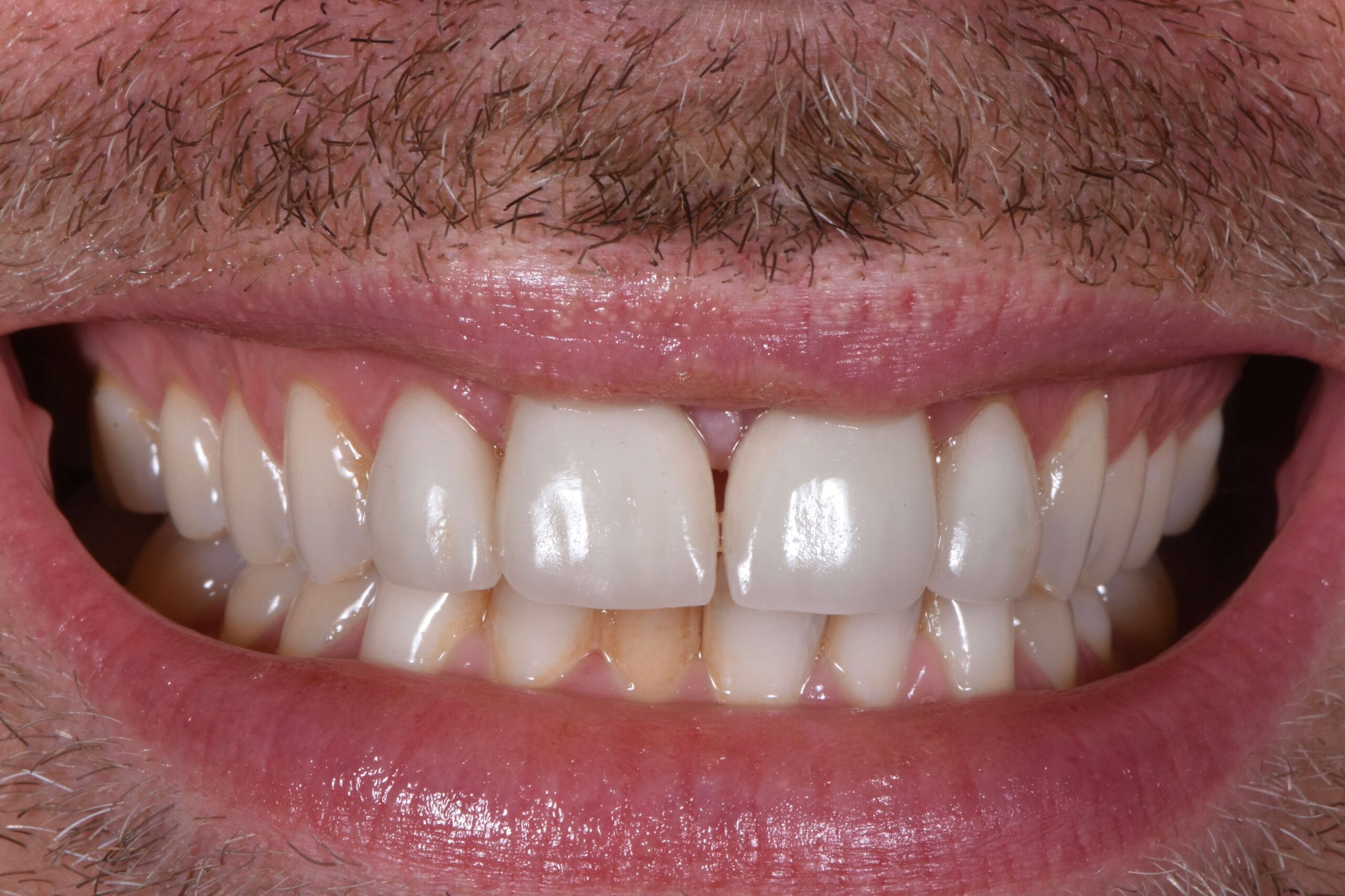 Dental Crowns — before