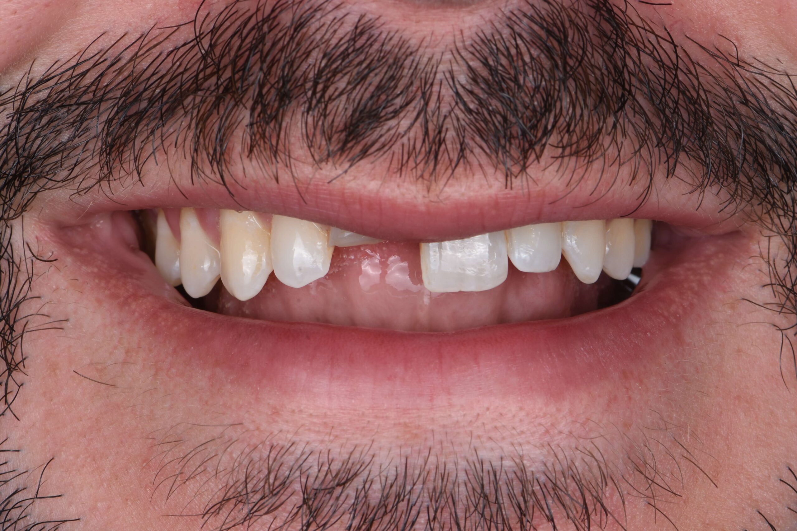 Tooth-Colored Fillings — before