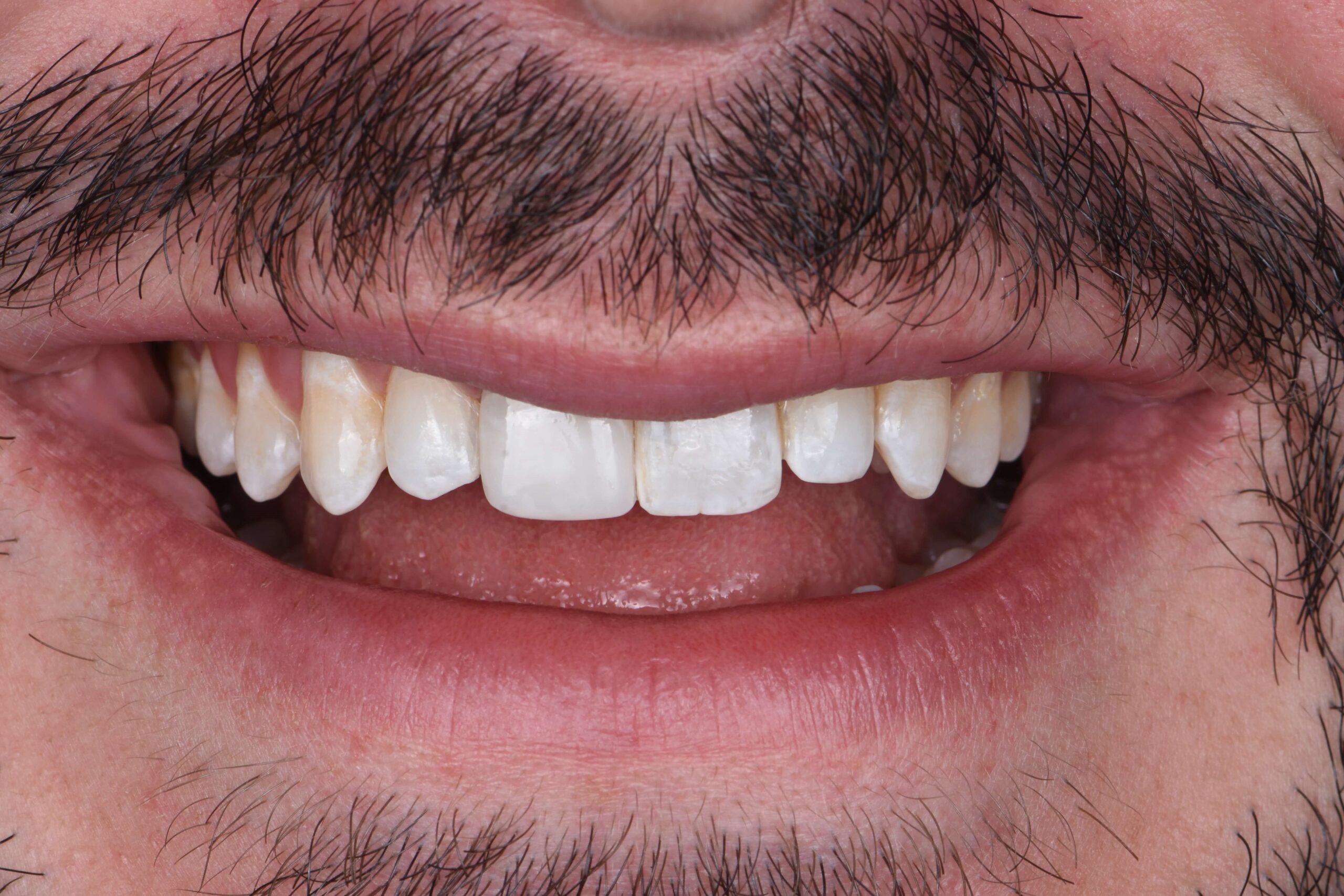 Tooth-Colored Fillings — after