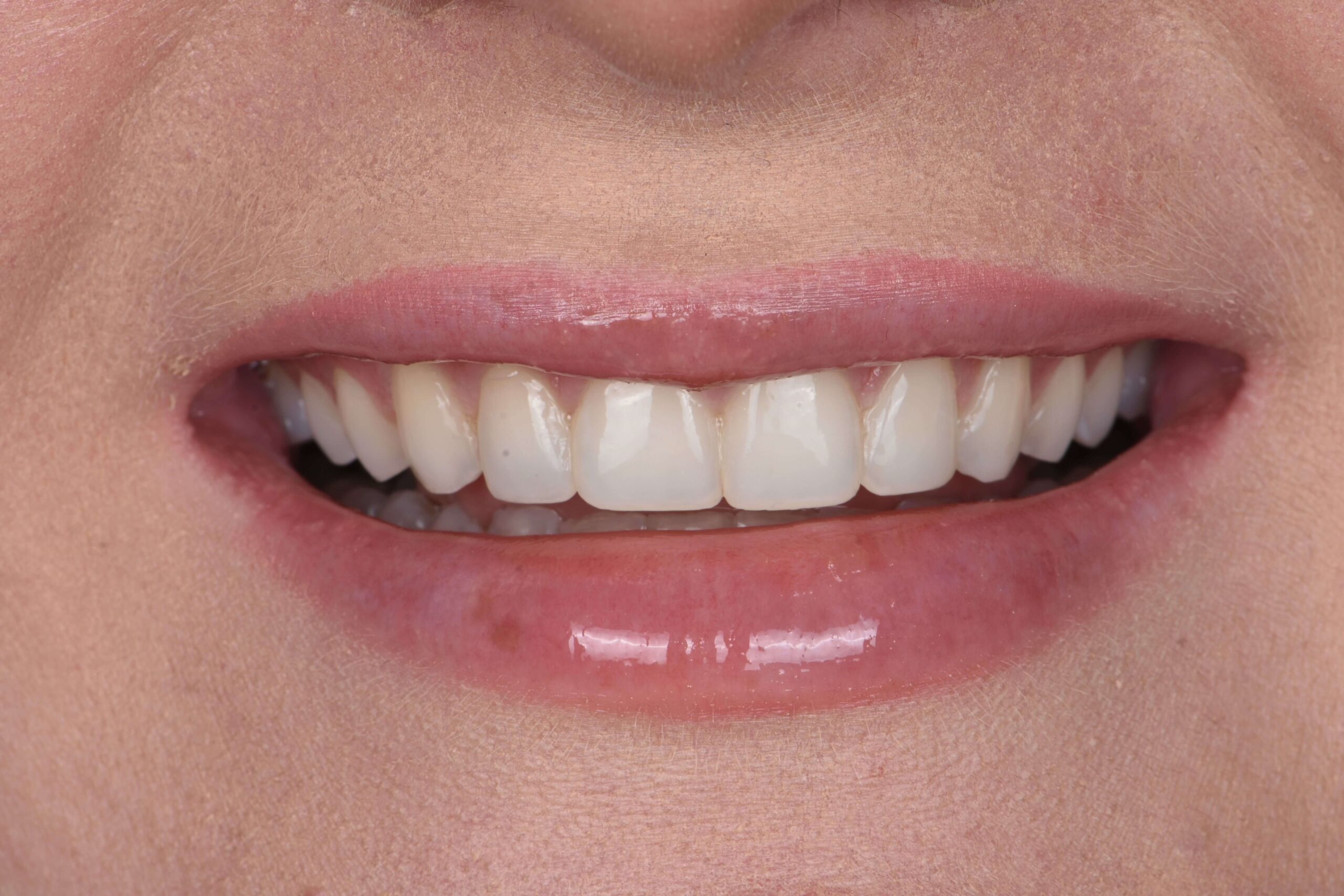 Composite Bonding & Contouring — after