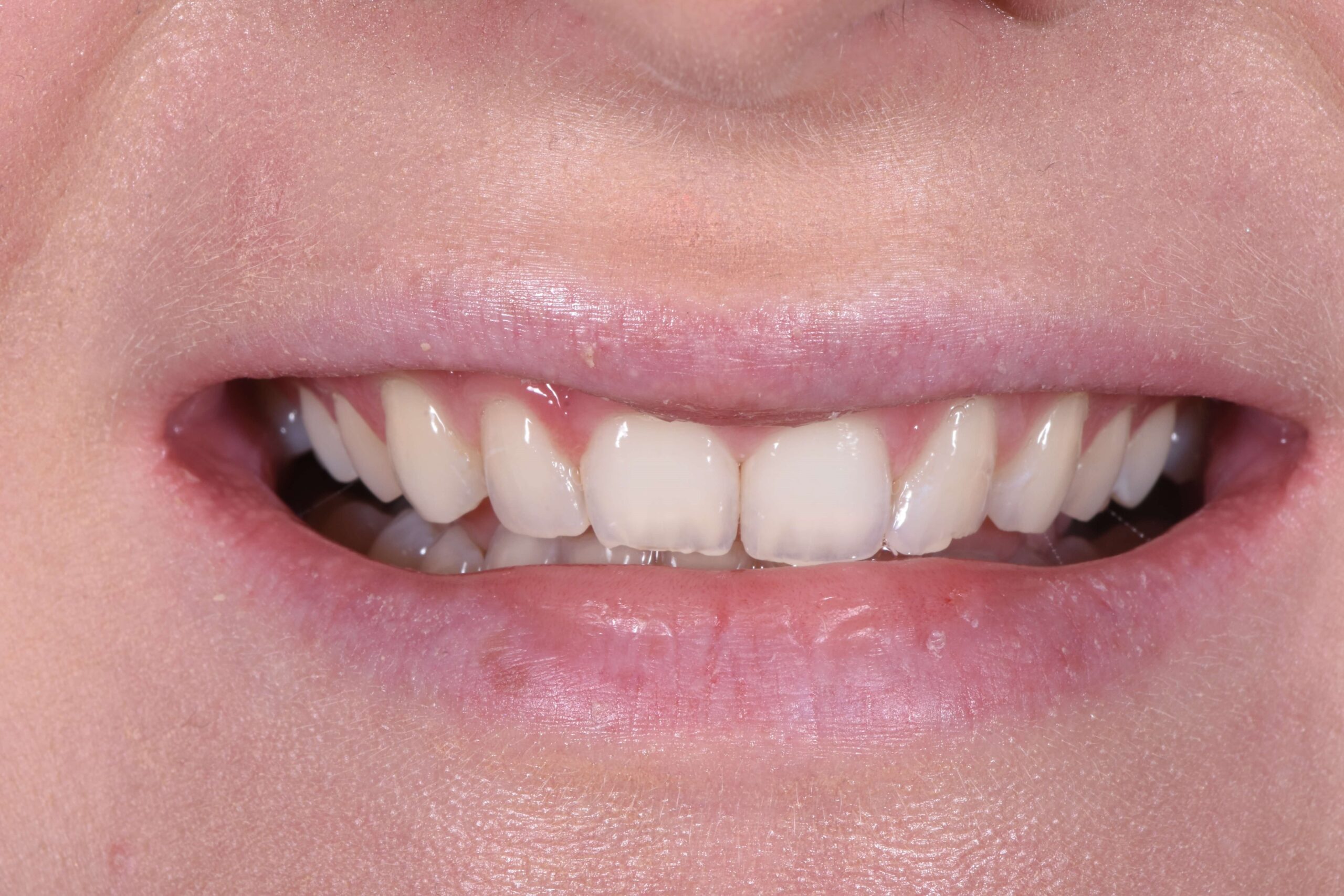 Composite Bonding & Contouring — before