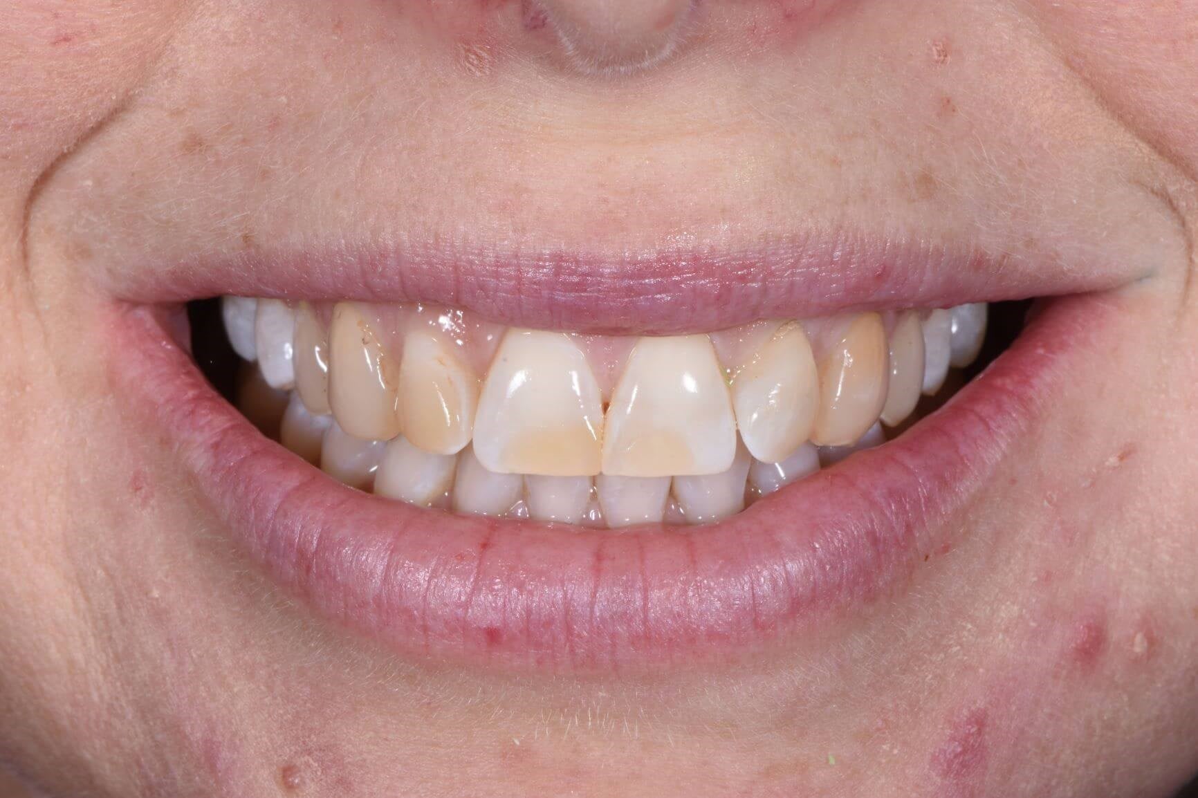 Invisalign® Treatment — before