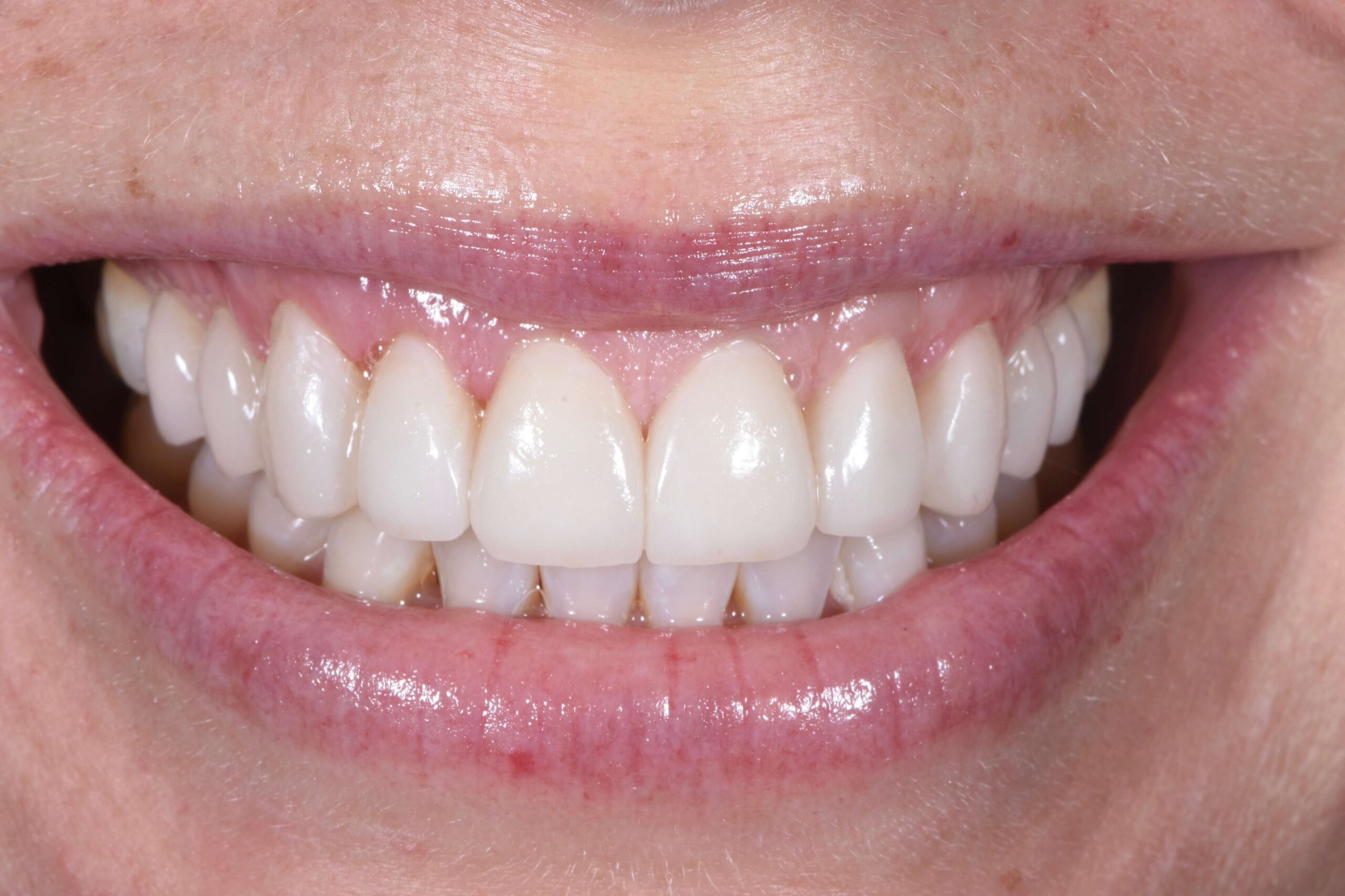 Invisalign® Treatment — after