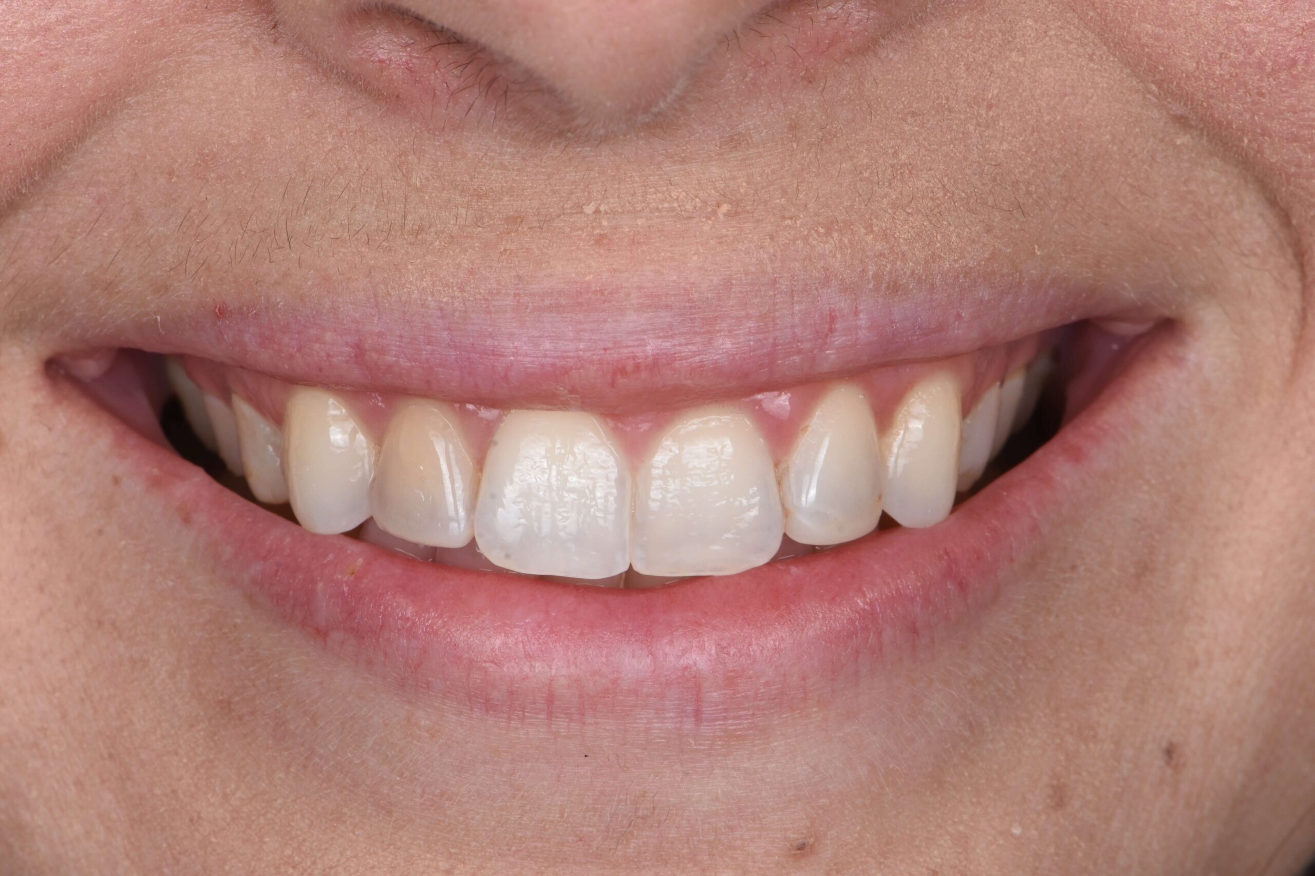 Smile Makeover — before