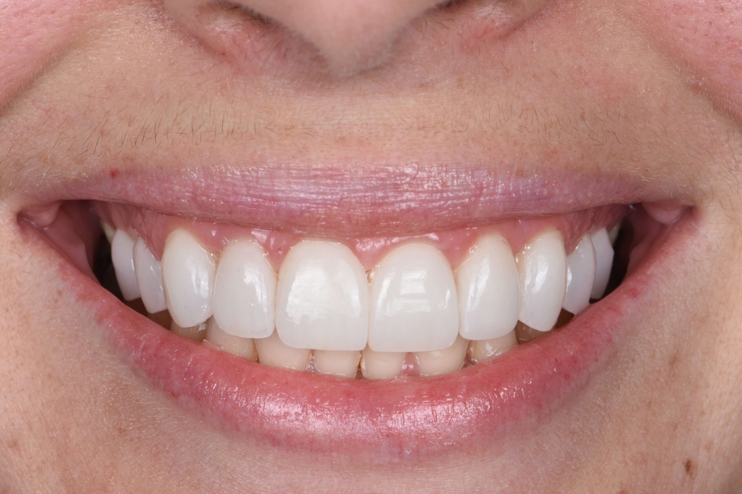 Smile Makeover — after