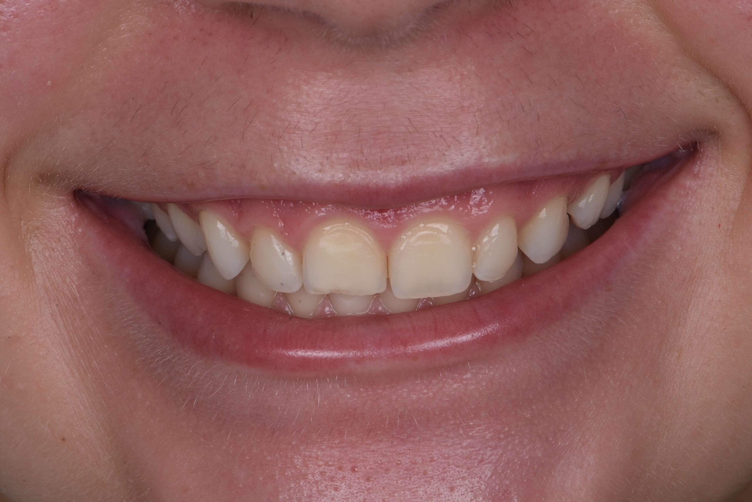 Smile Makeover — before