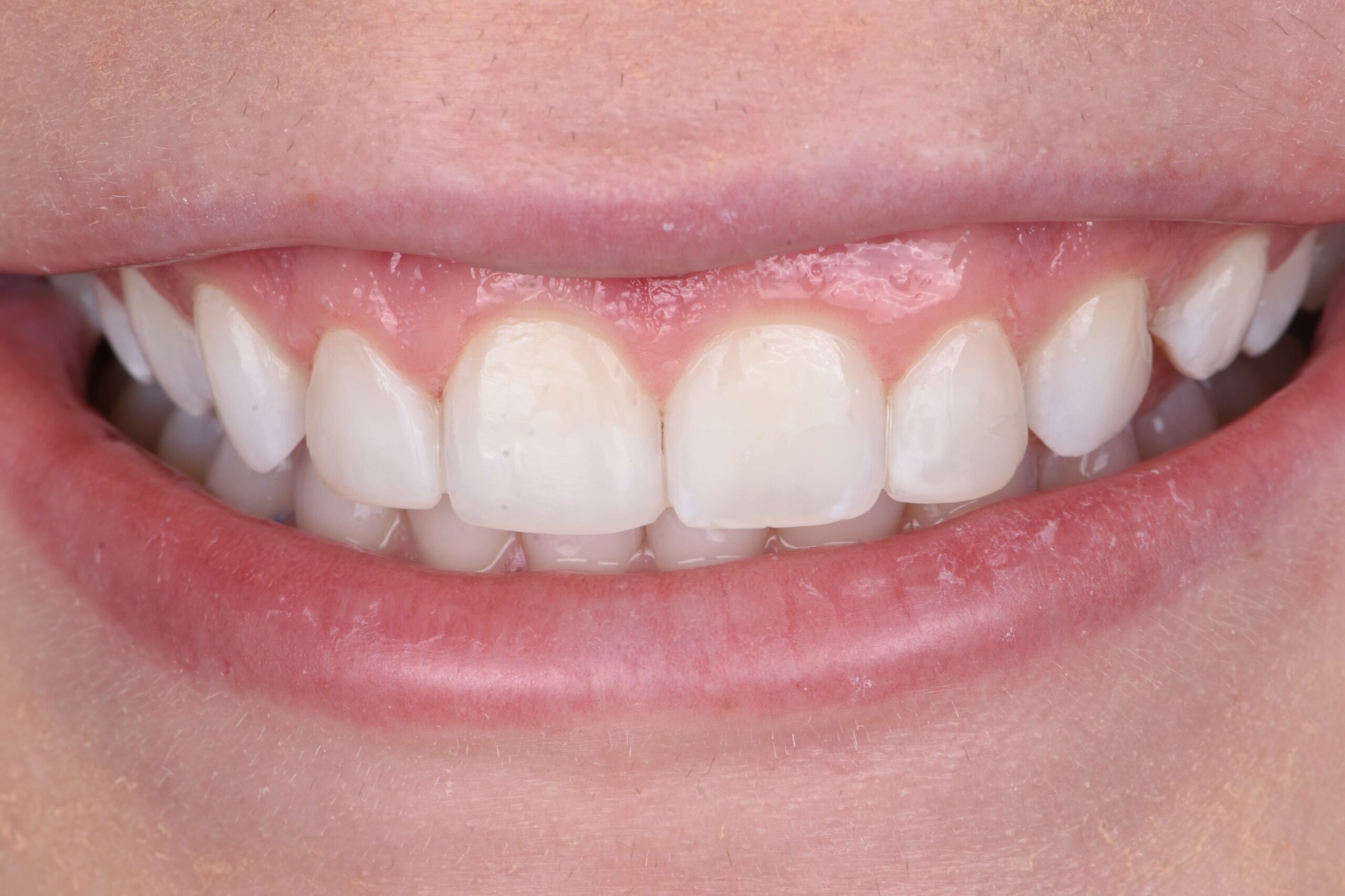 Smile Makeover — after