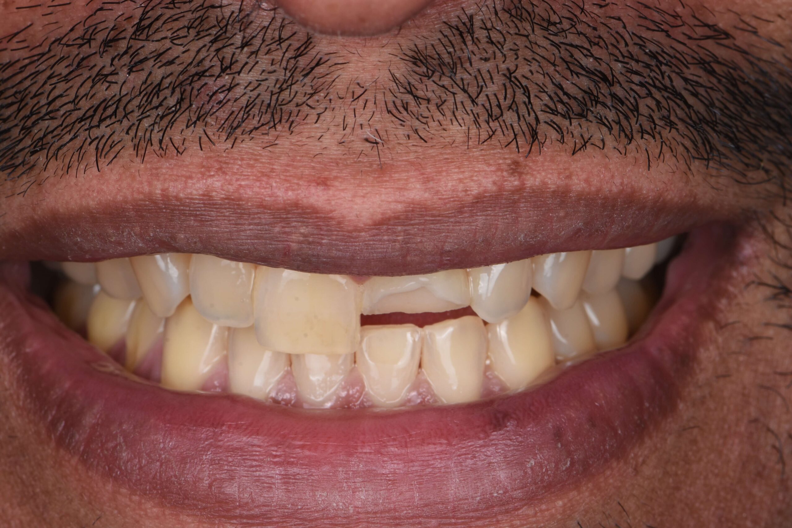 Teeth Whitening — before