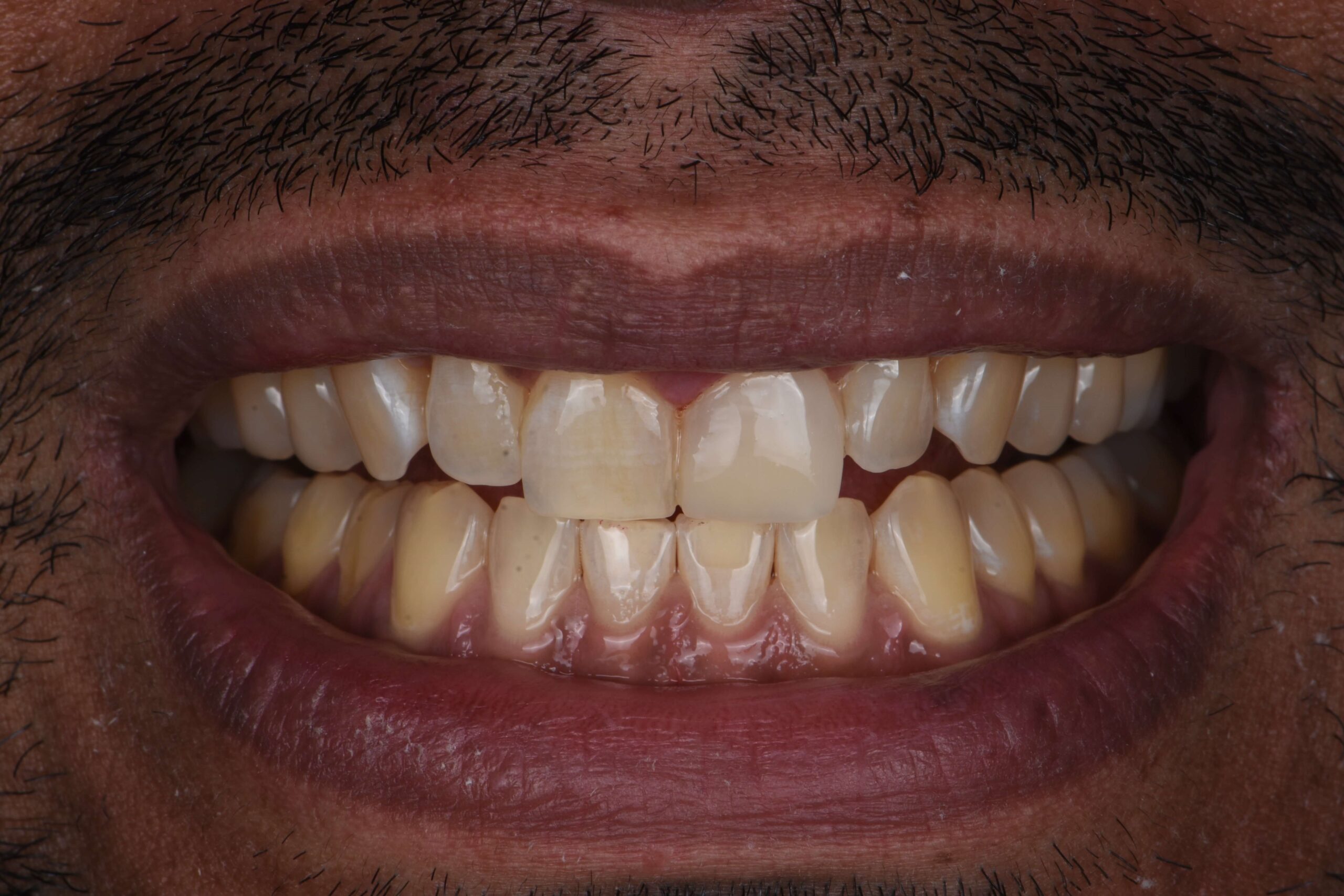 Teeth Whitening — after