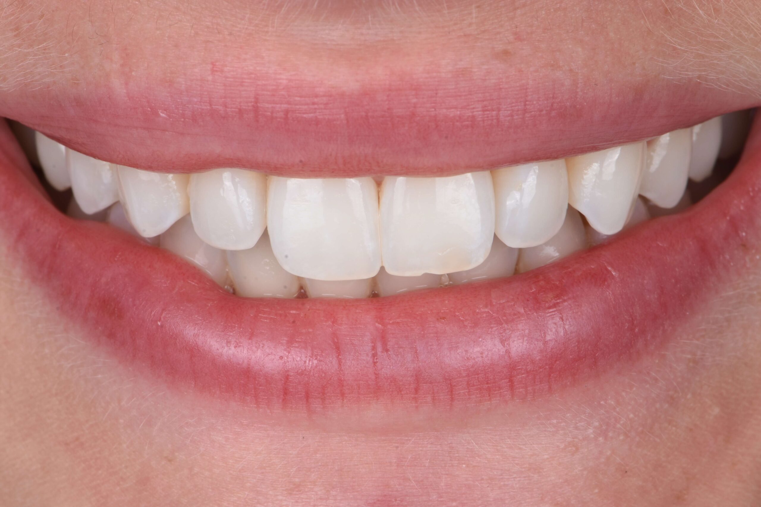 Smile Makeover — before