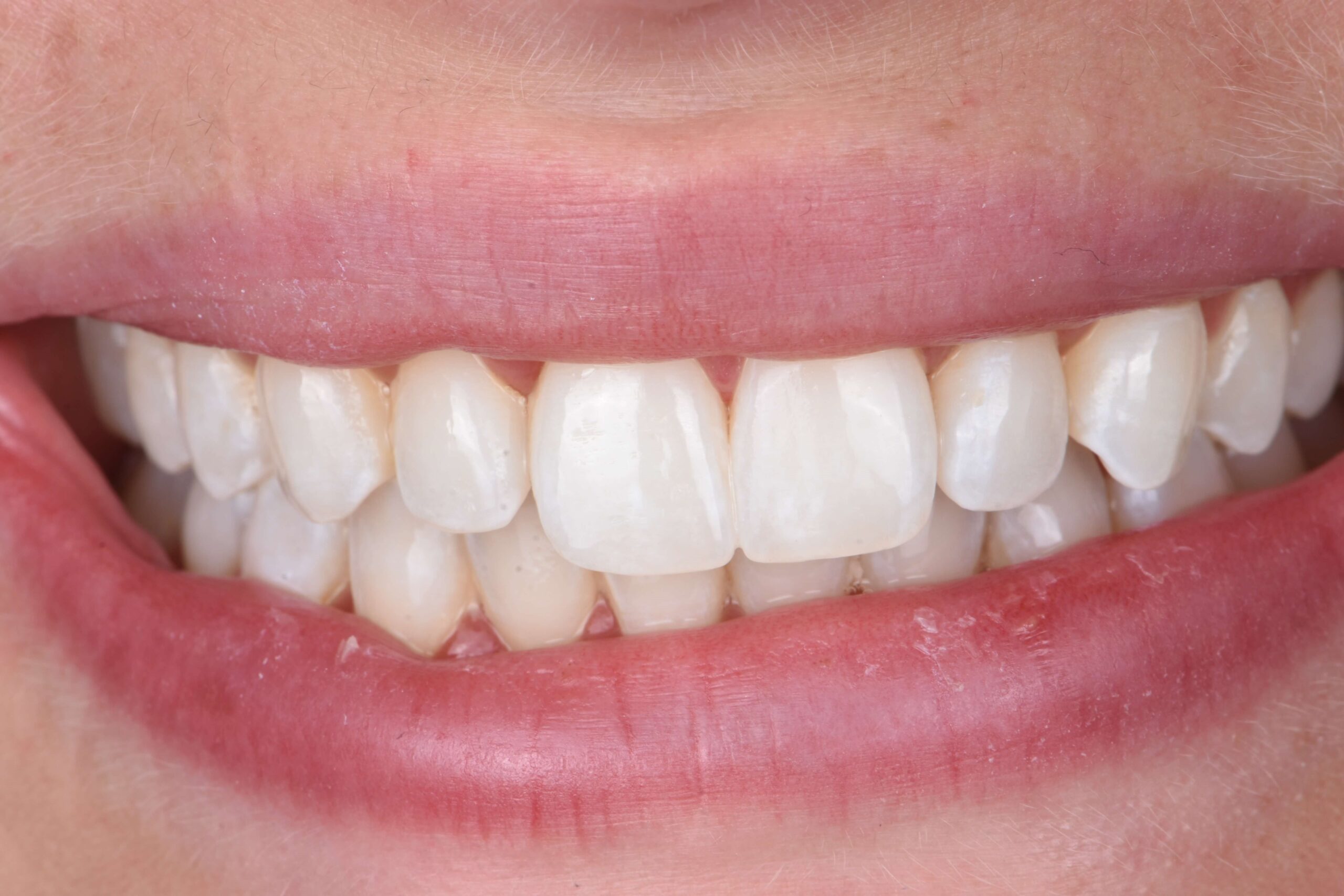 Smile Makeover — after
