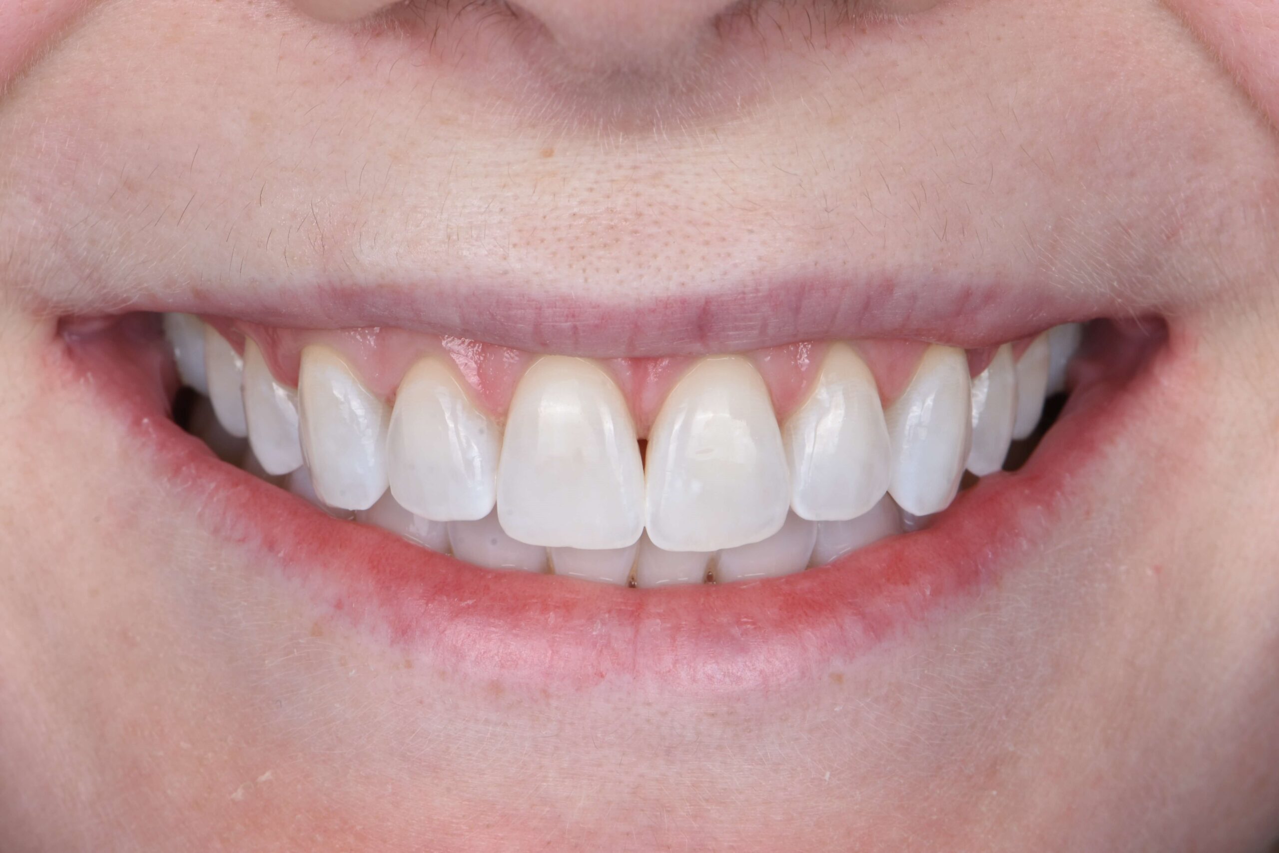 Smile Makeover — after