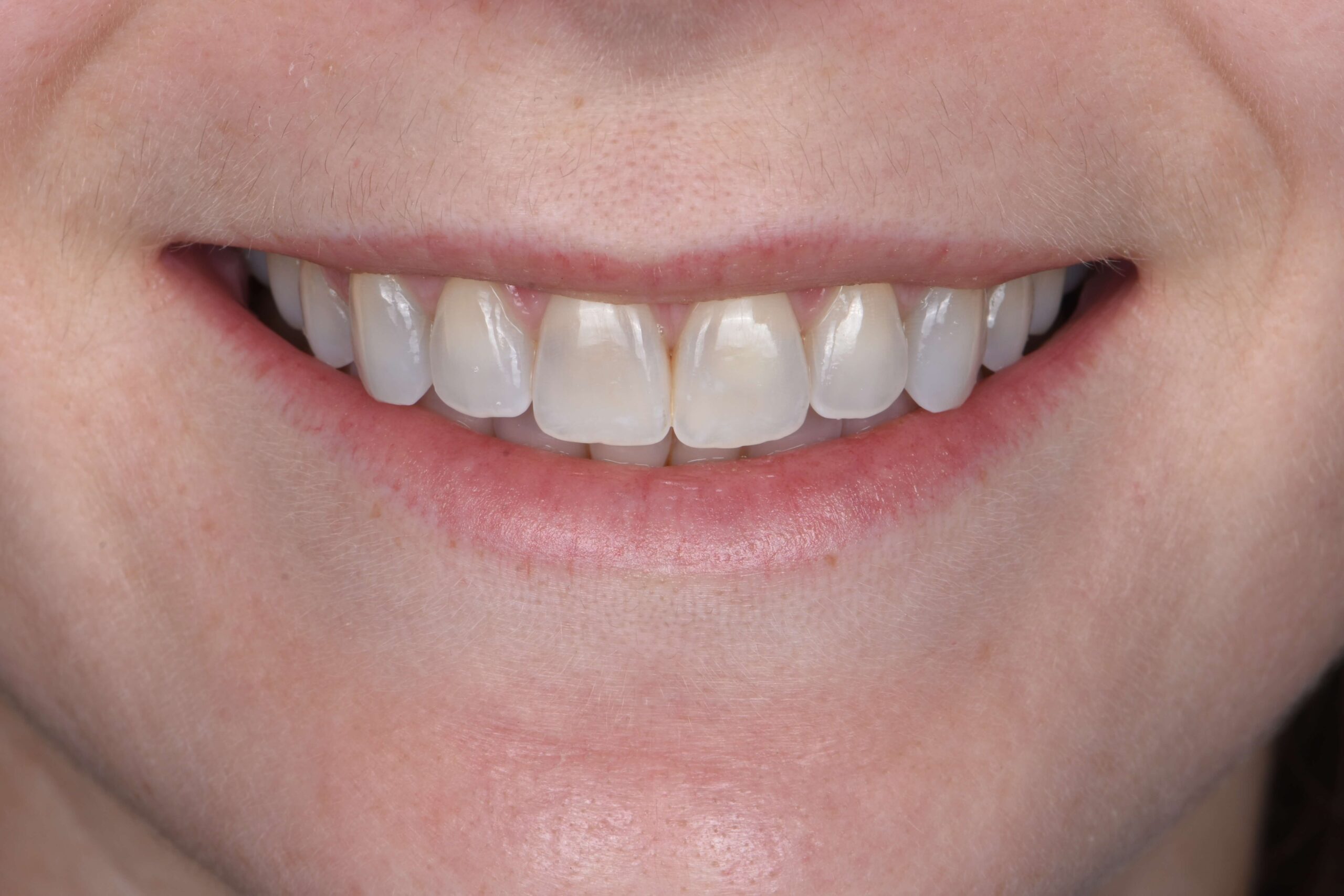 Smile Makeover — before