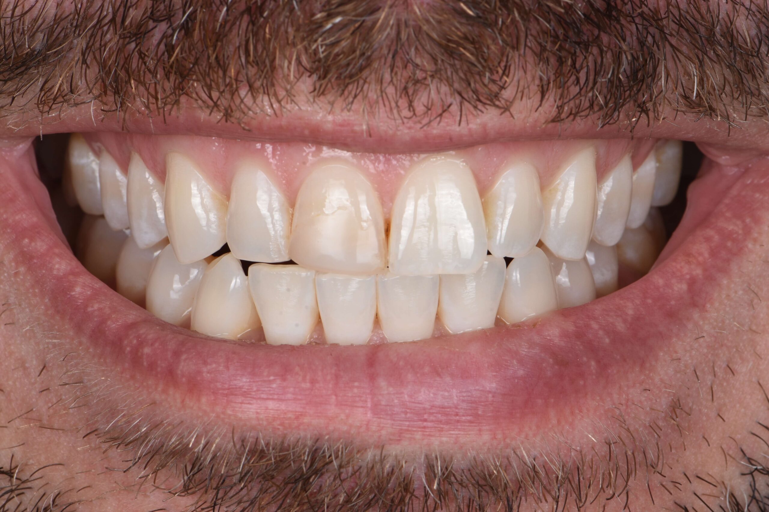Composite Bonding & Contouring — before