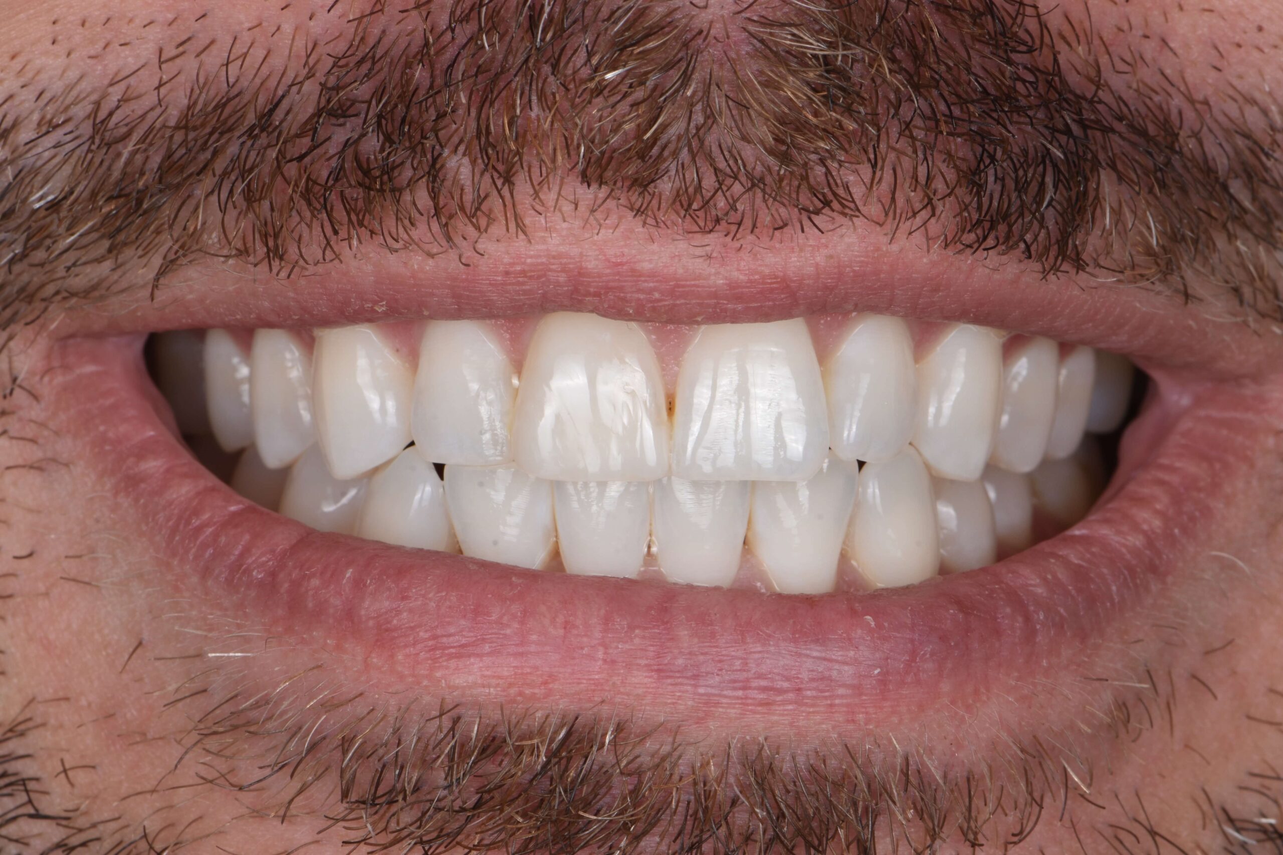 Composite Bonding & Contouring — after