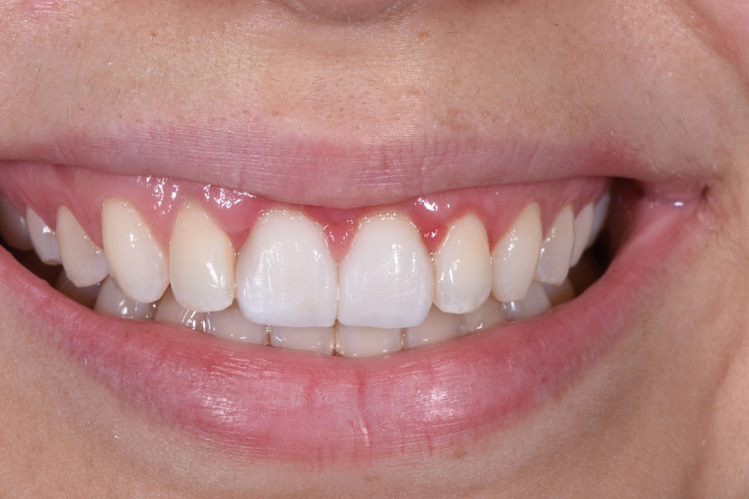 Aesthetic Crown Lengthening — before
