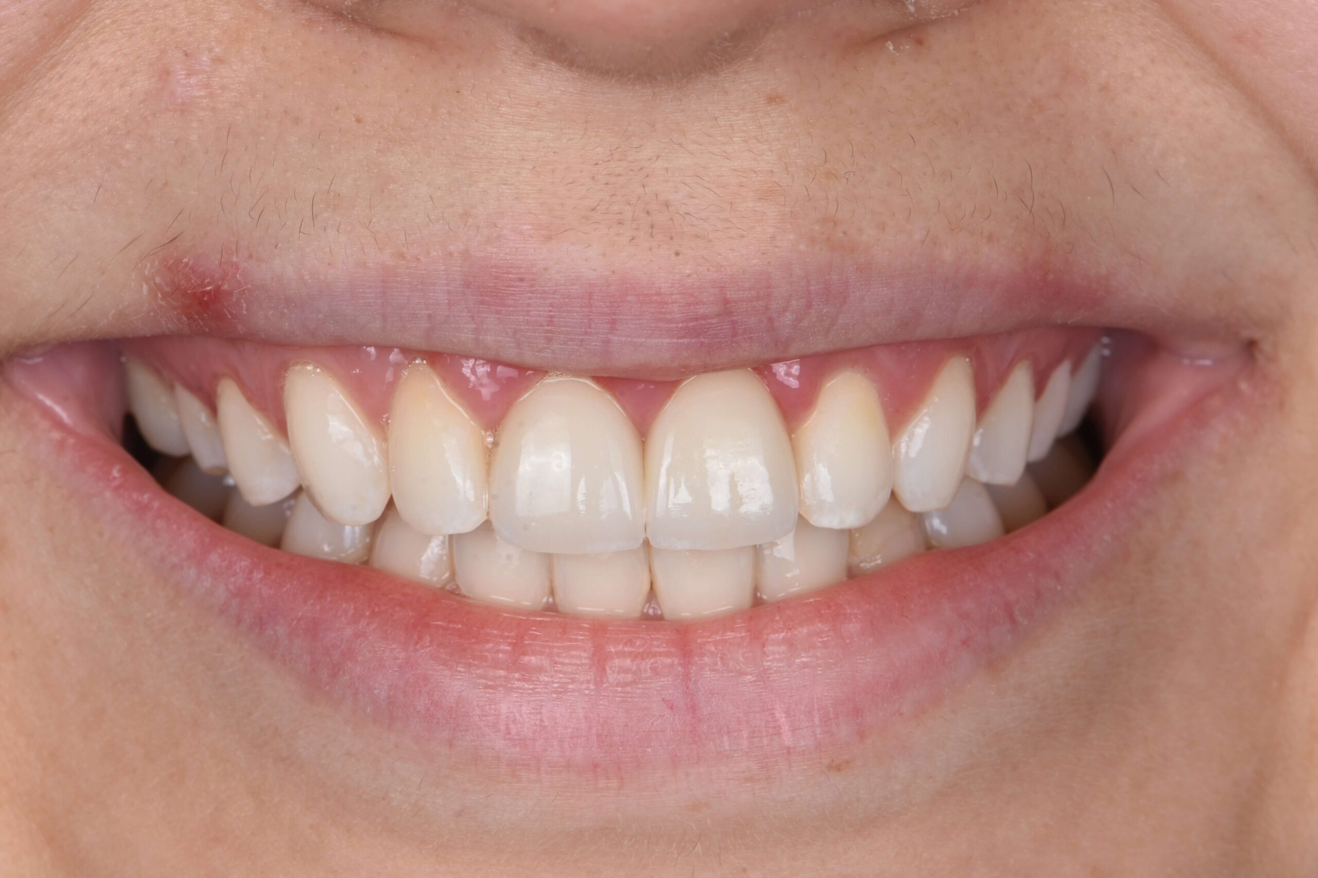 Aesthetic Crown Lengthening — after
