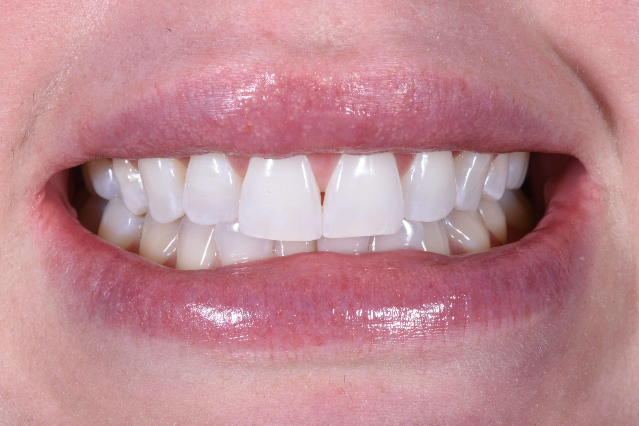 Composite Bonding & Contouring — before
