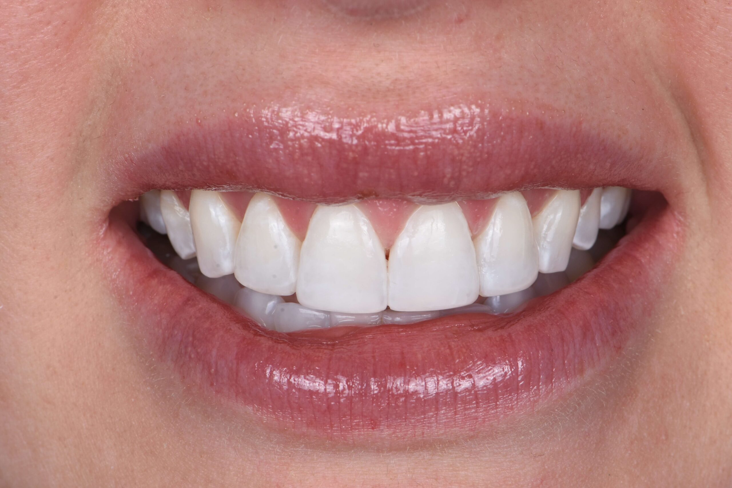 Composite Bonding & Contouring — after