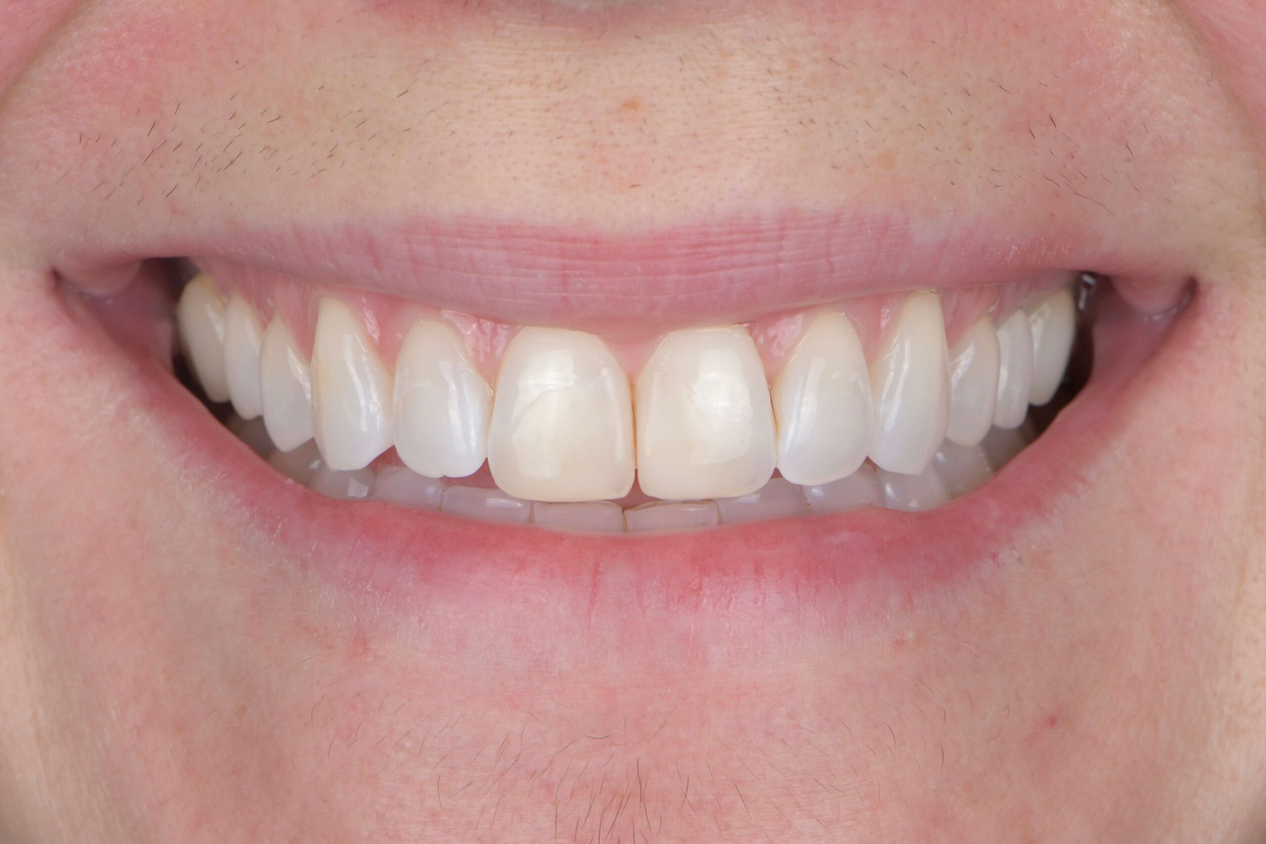 Composite Bonding & Contouring — before