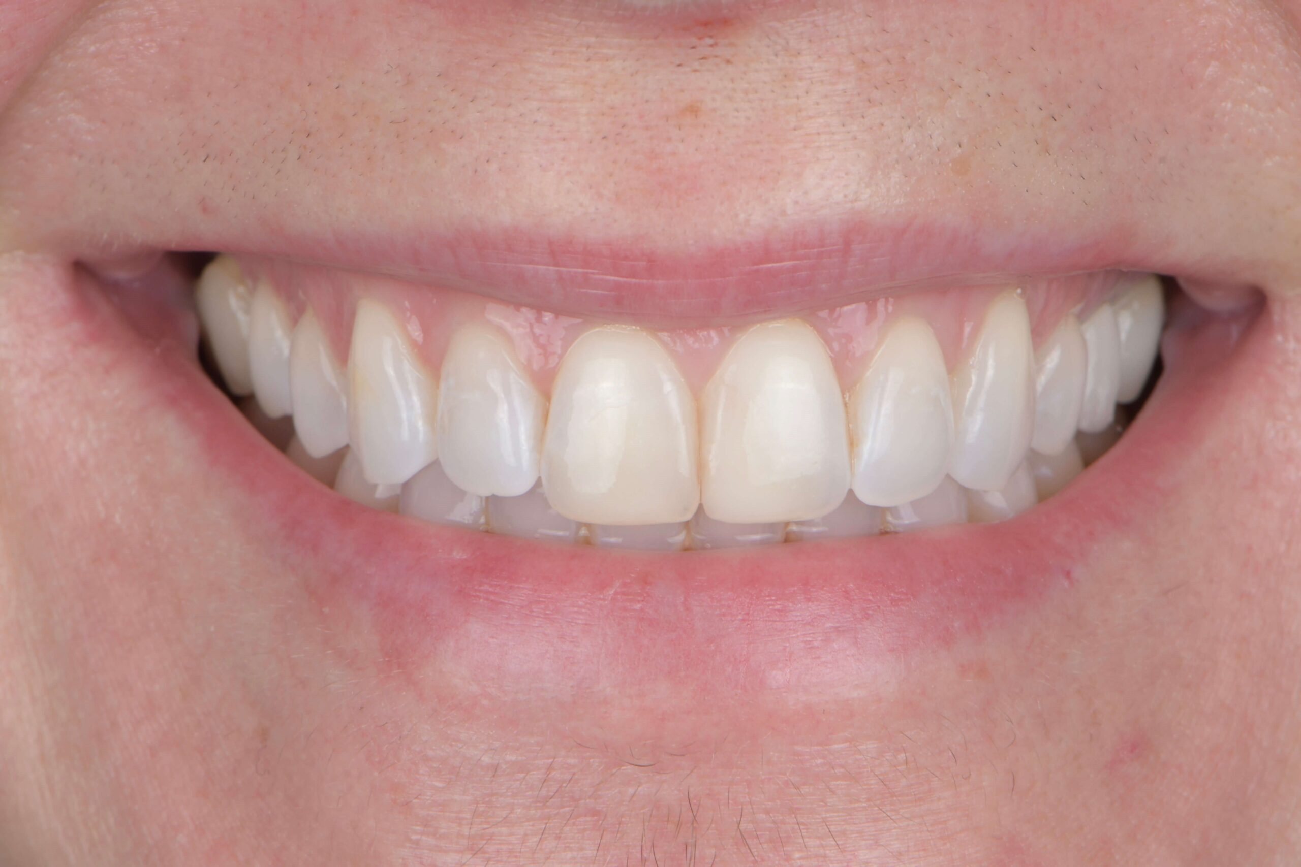 Composite Bonding & Contouring — after