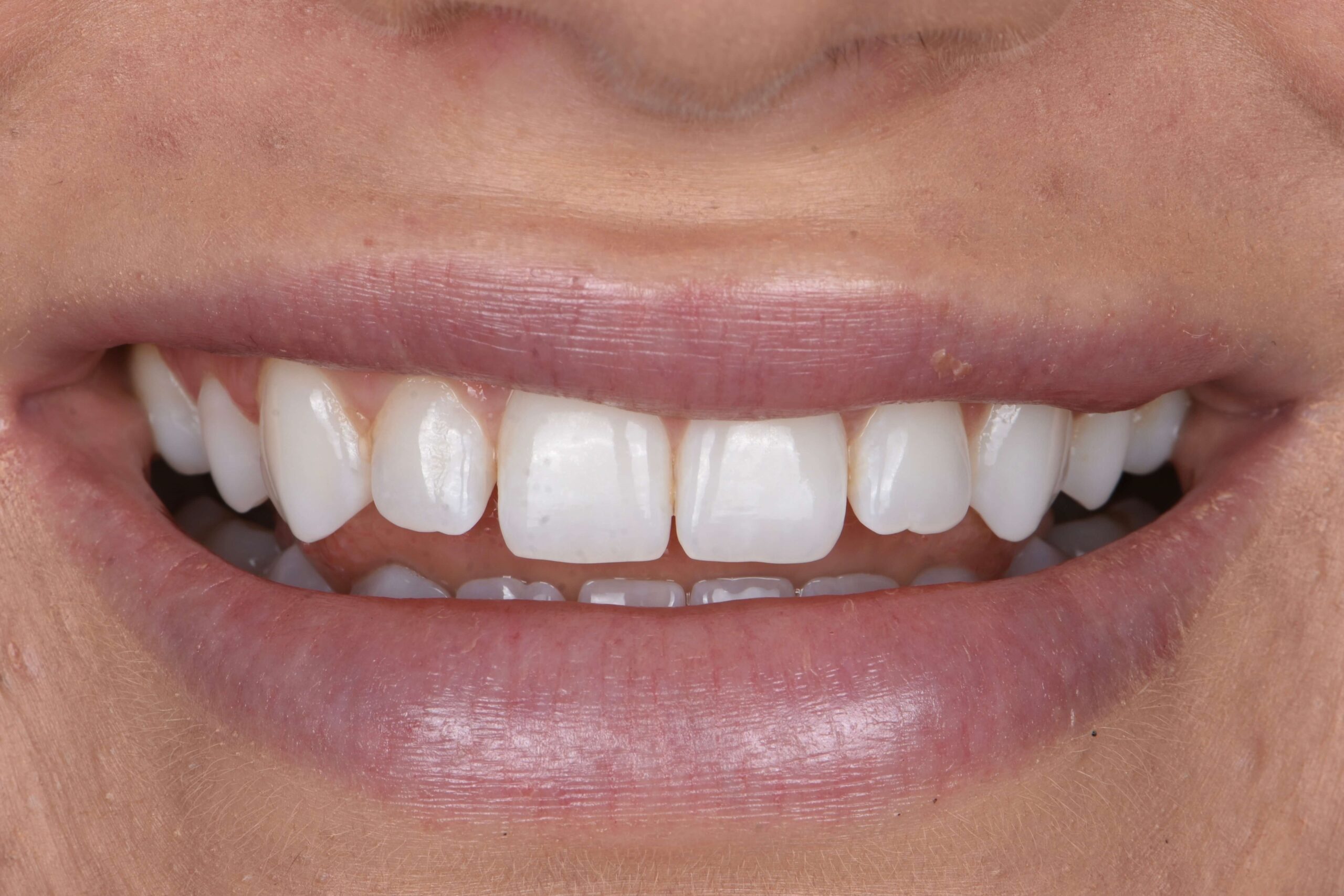 Composite Bonding & Contouring — before