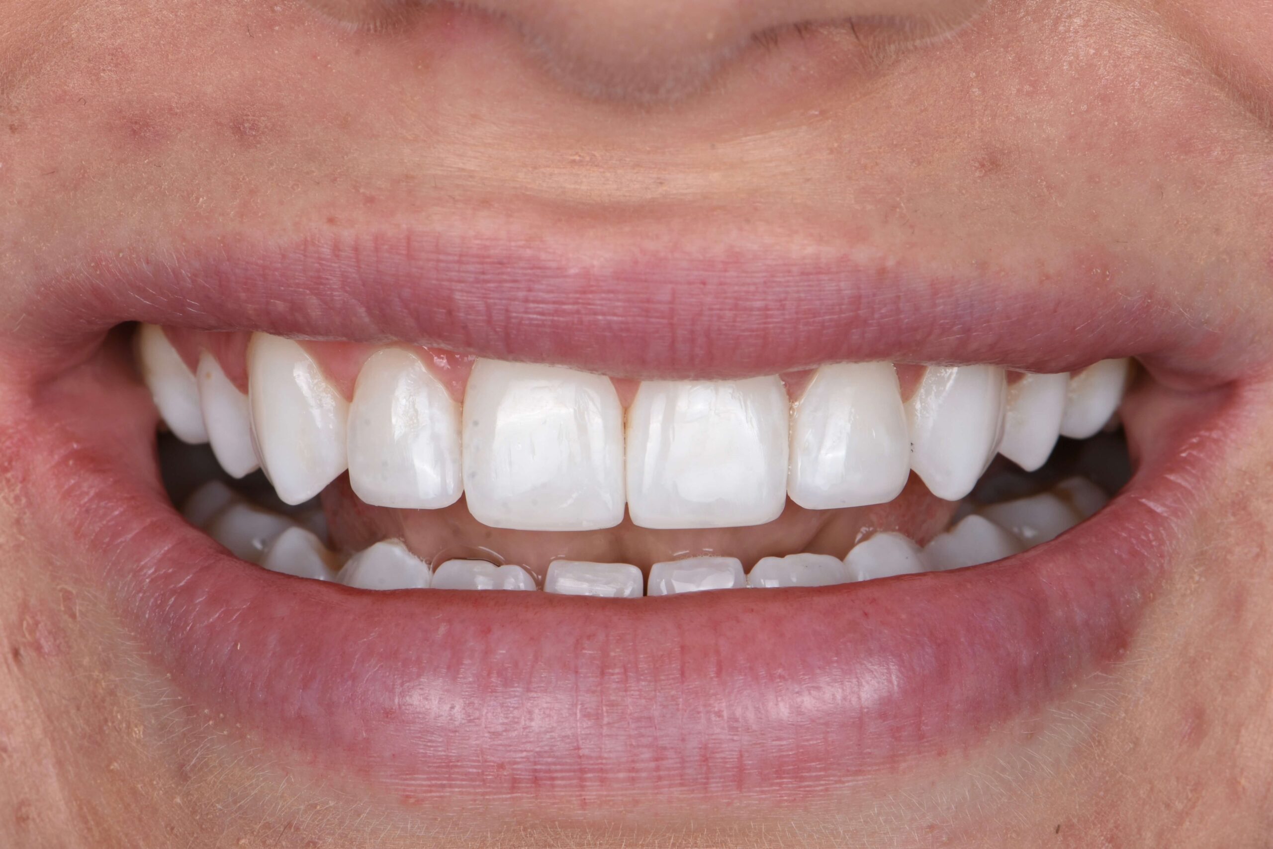Composite Bonding & Contouring — after