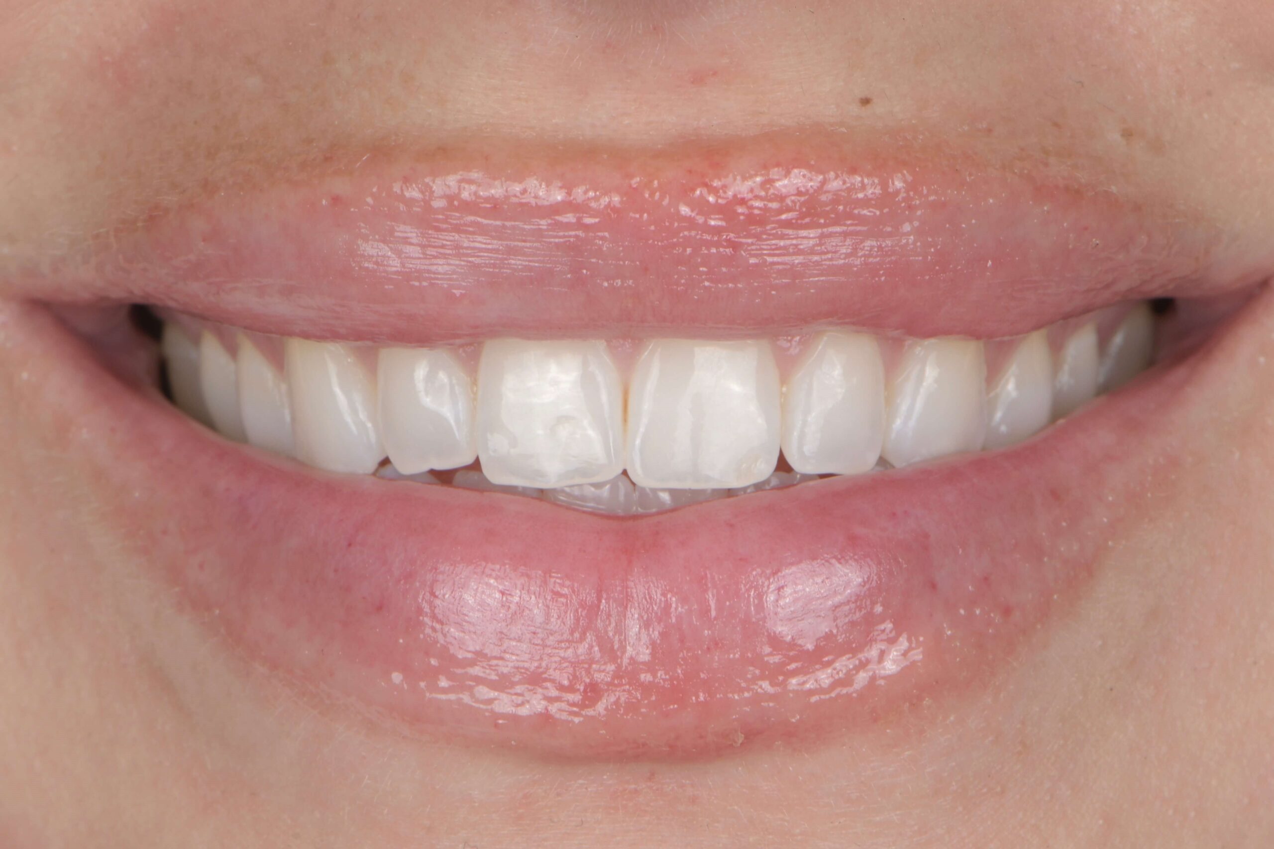 Composite Veneers — before