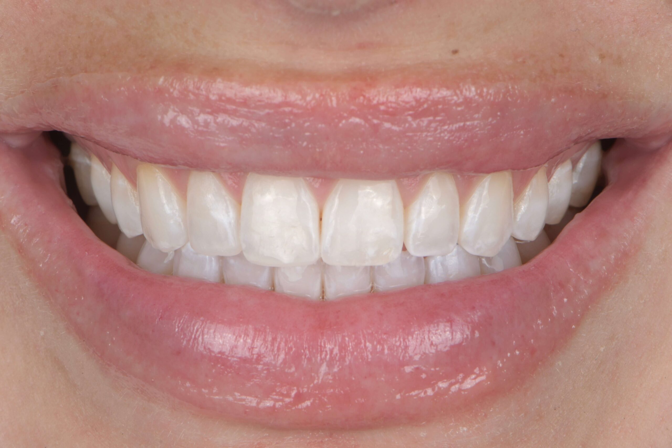 Composite Veneers — after