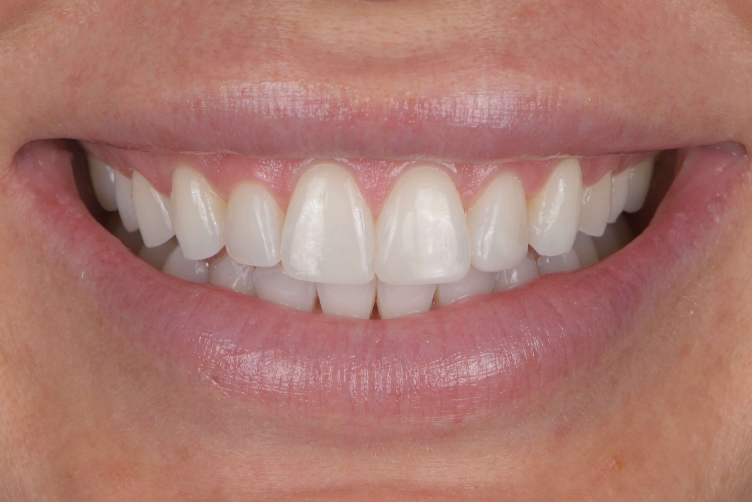 KöR® Whitening — after
