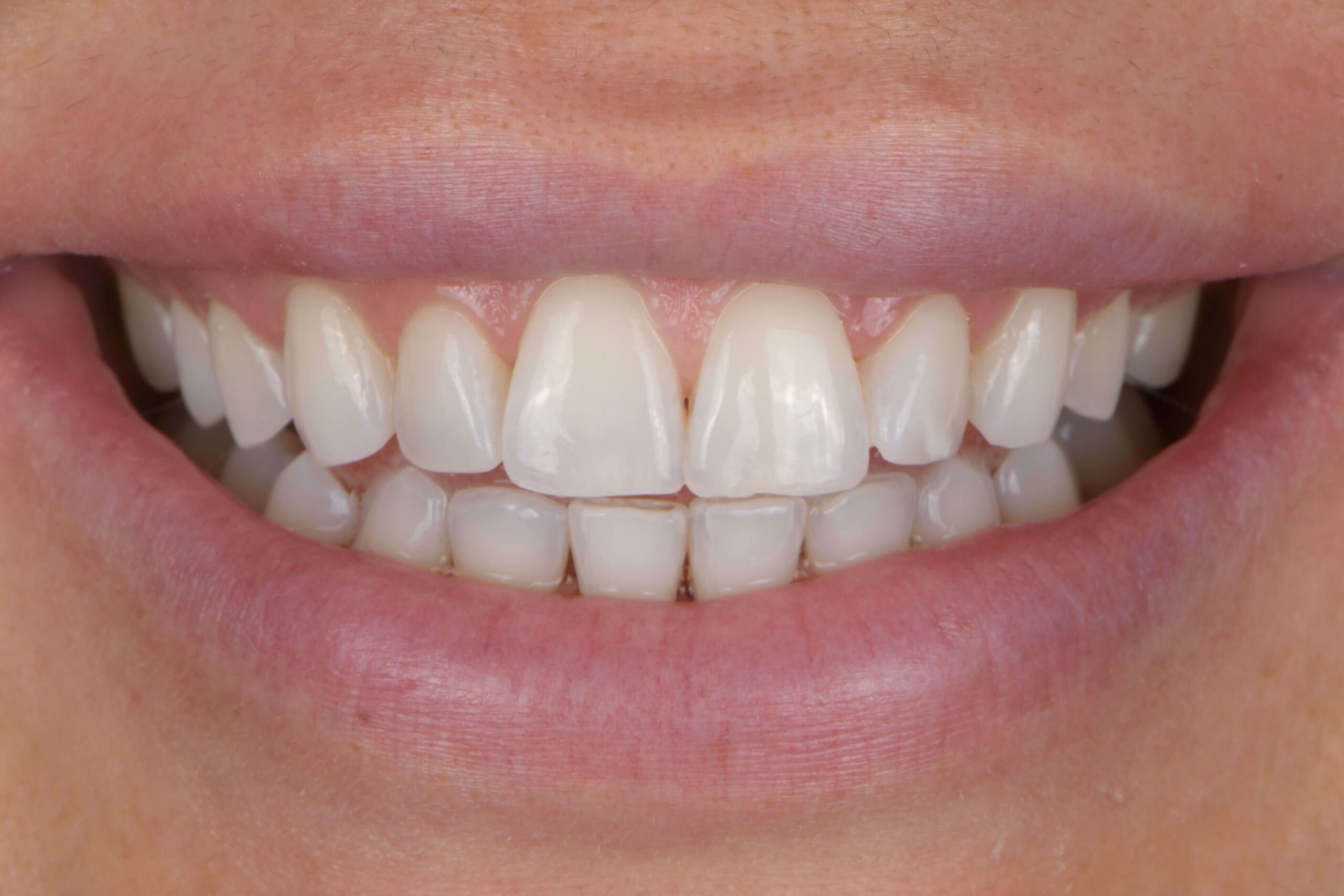 KöR® Whitening — before