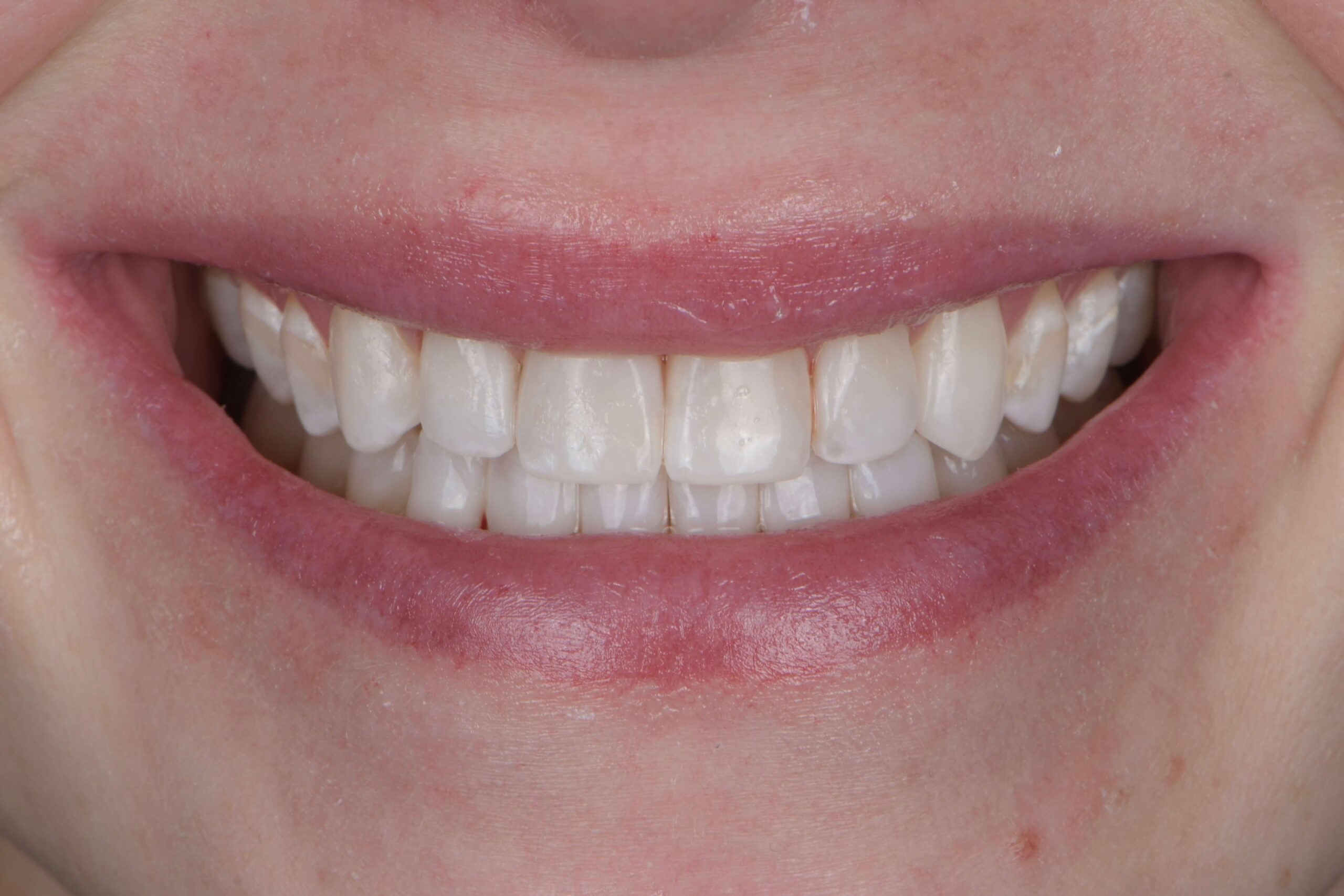 Composite Veneers — after