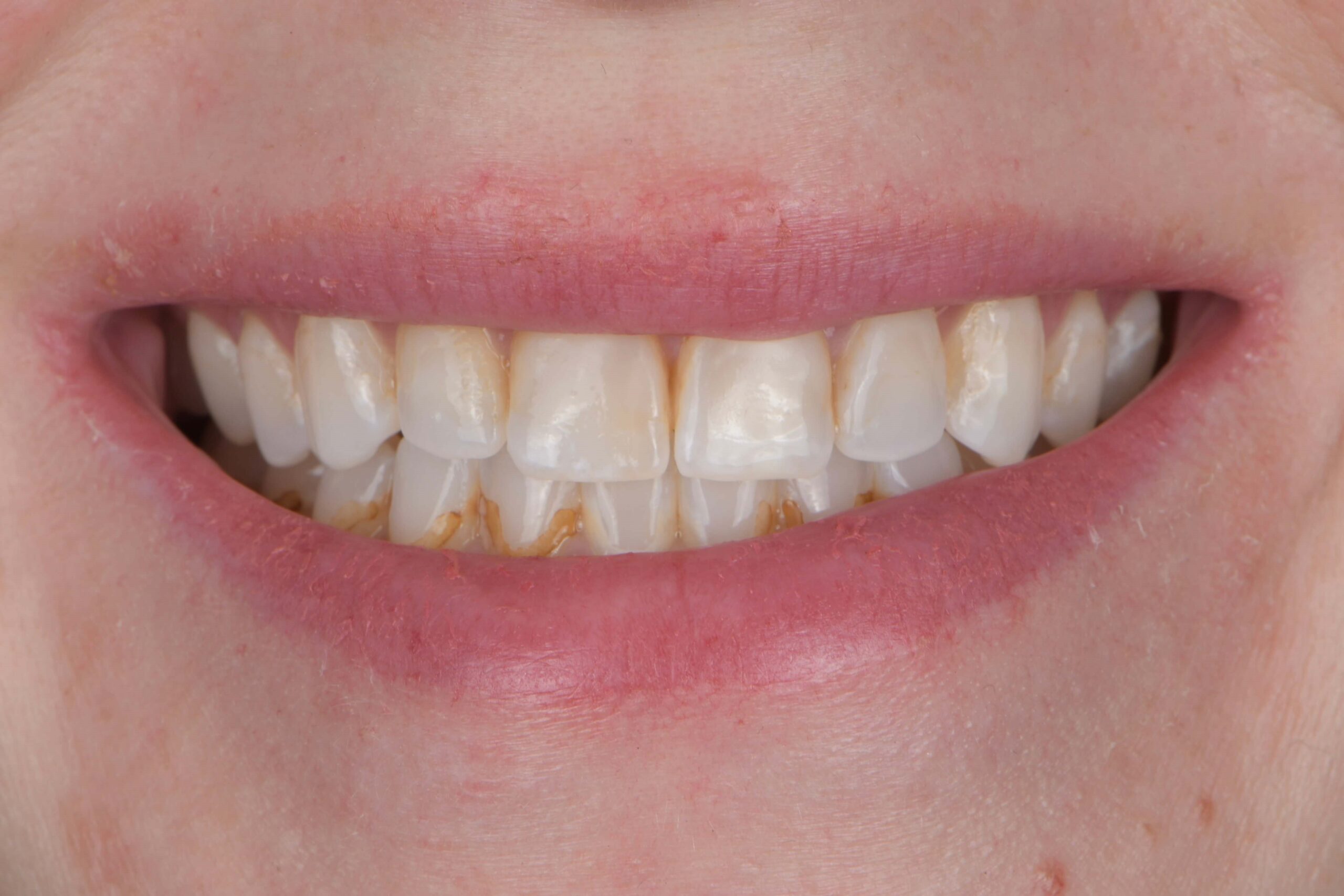 Composite Veneers — before