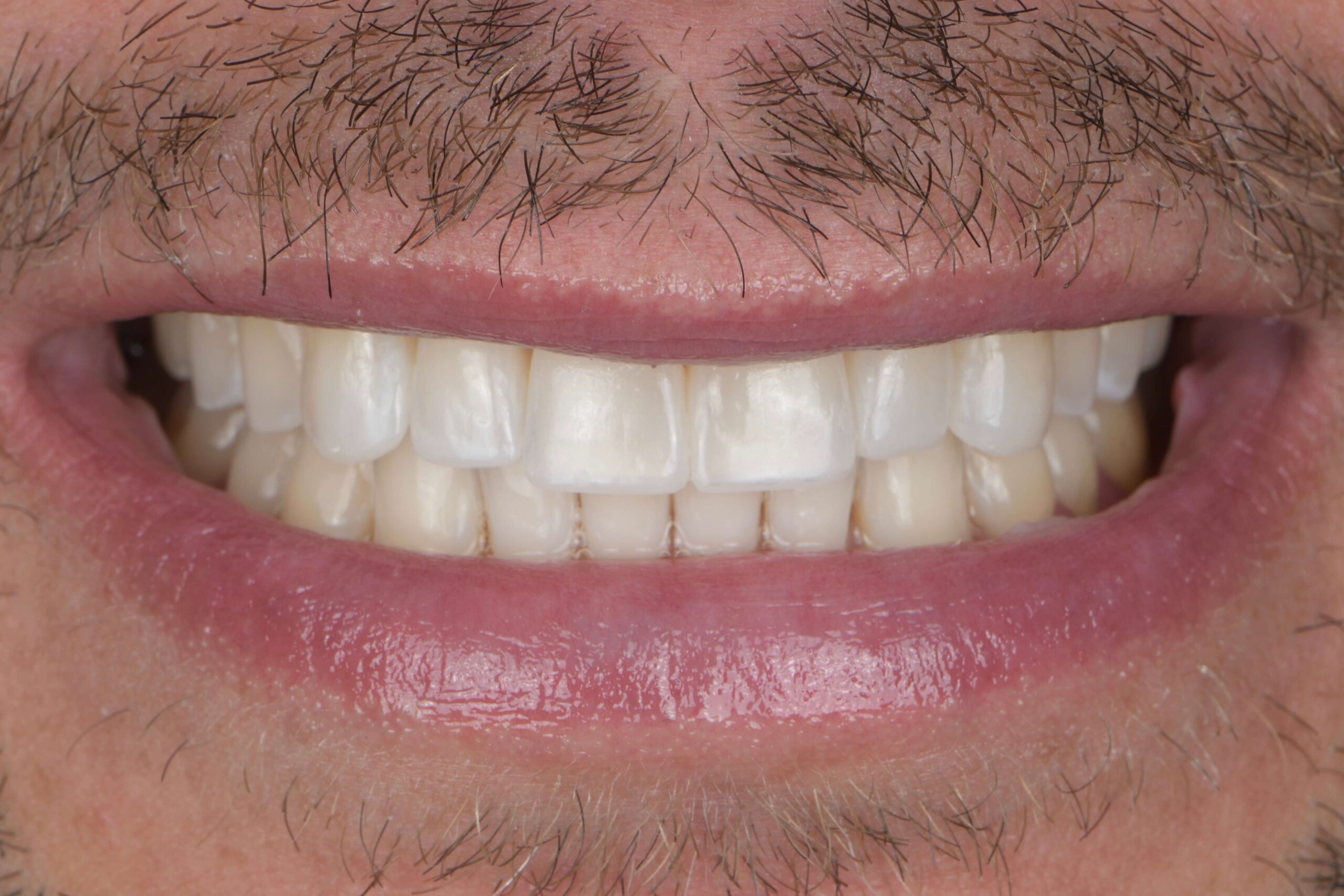 Smile Makeover — after