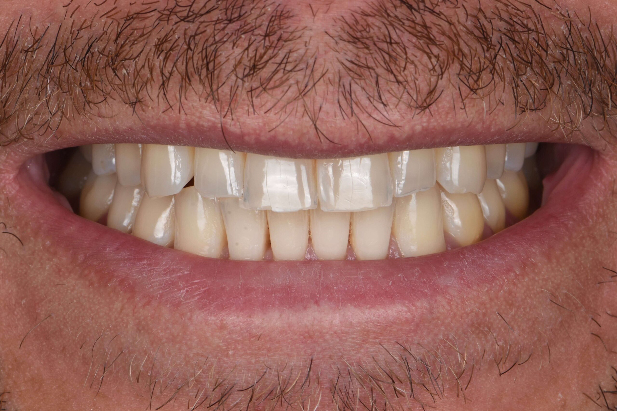 Smile Makeover — before