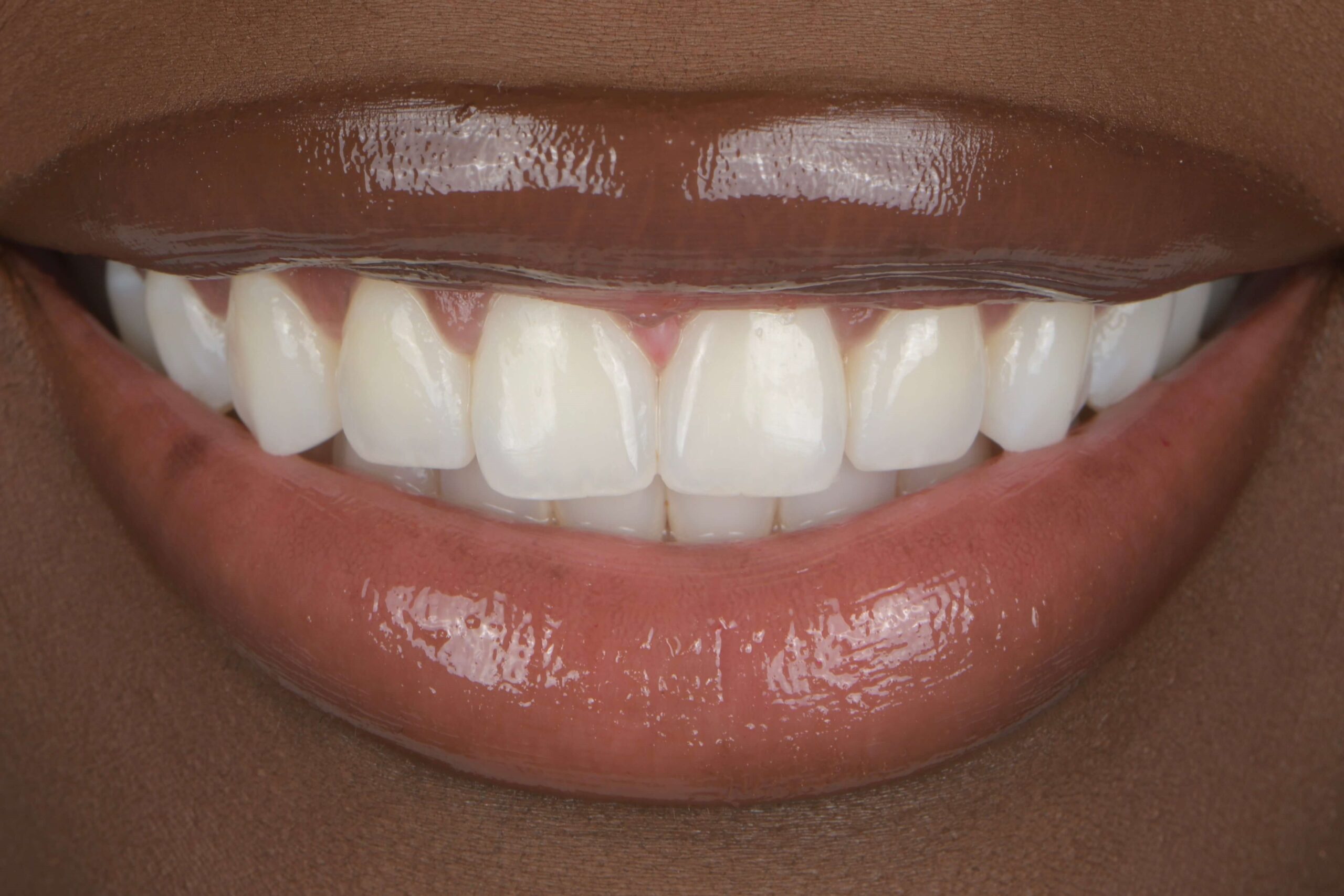 KöR® Whitening — after