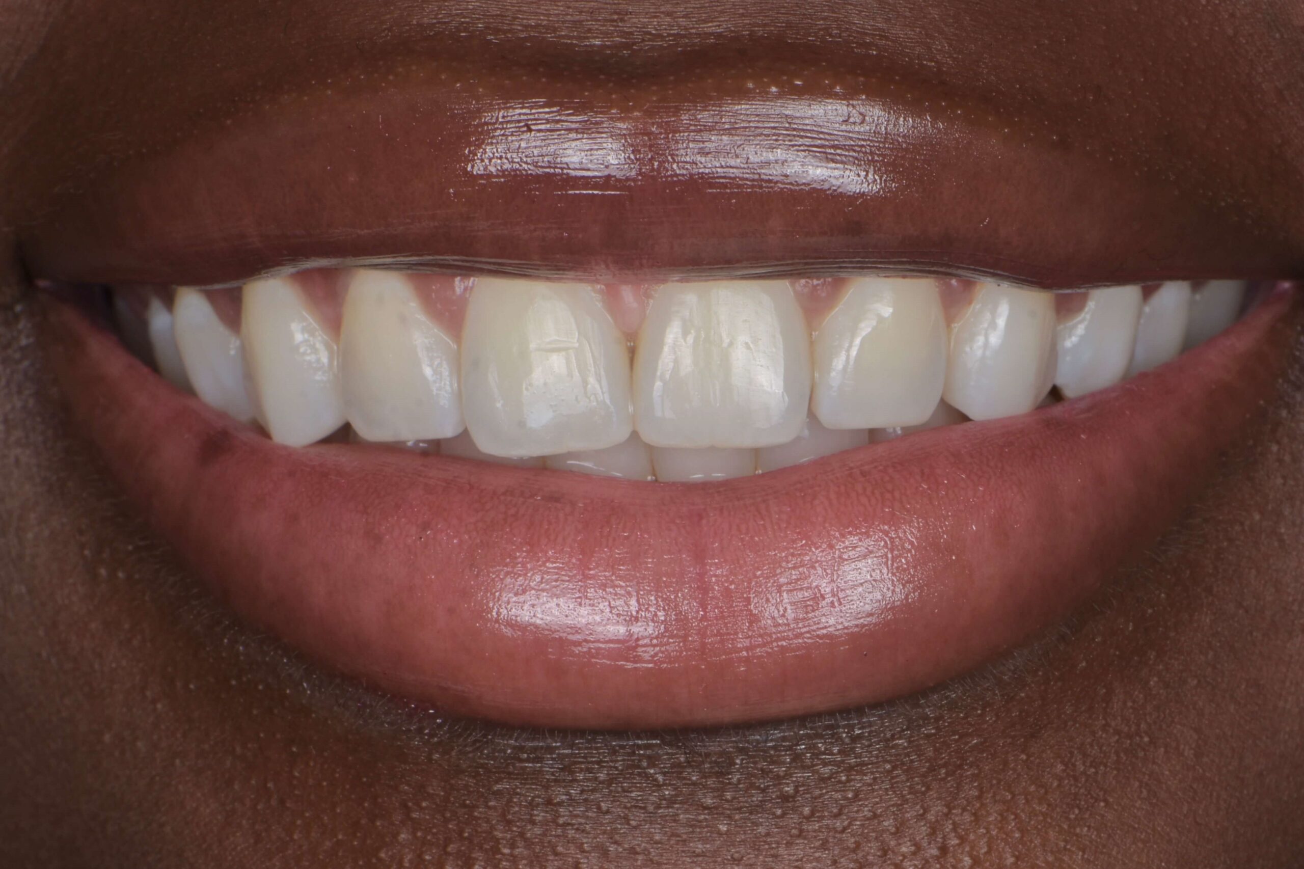 KöR® Whitening — before