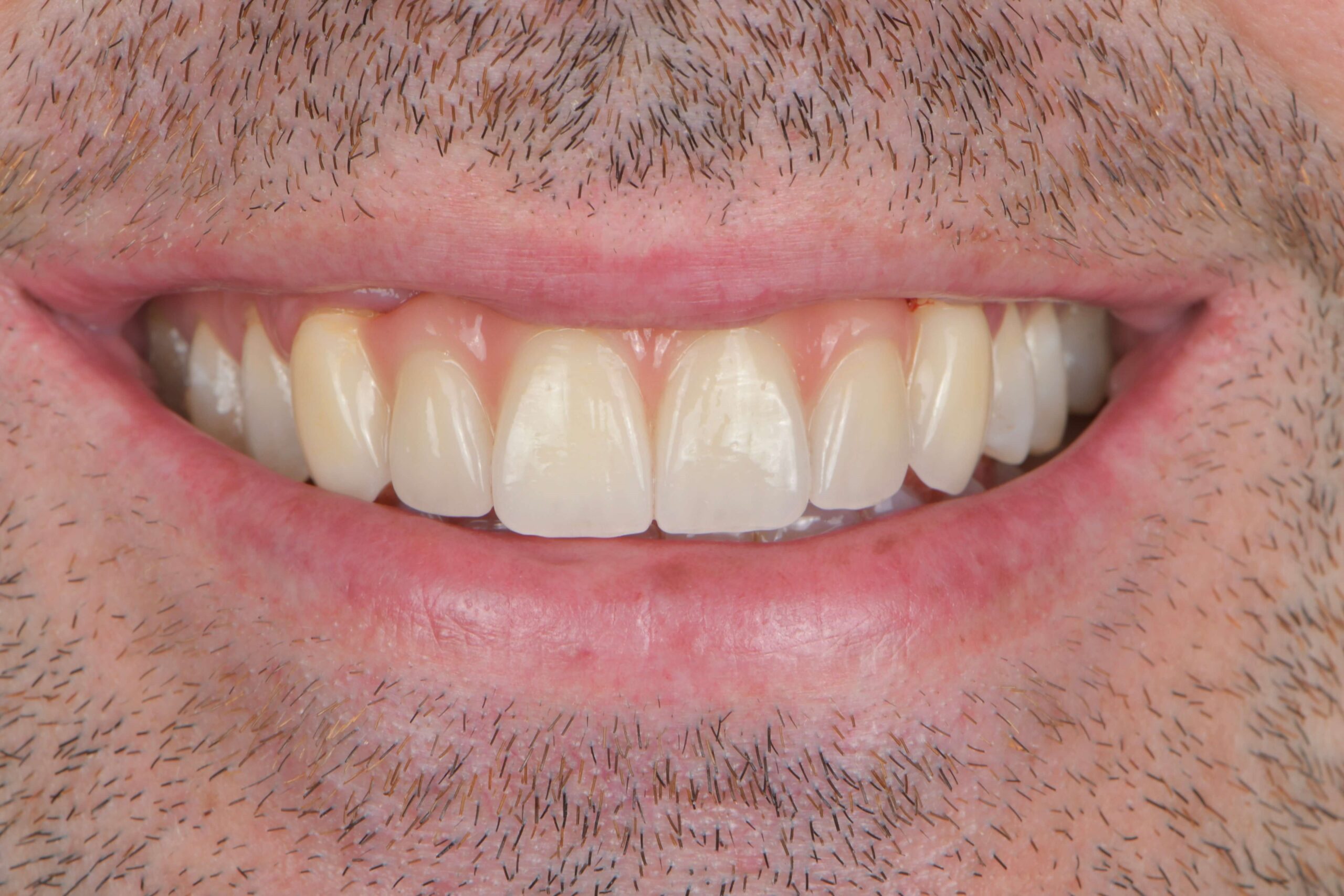 Emergency Dental Care — after