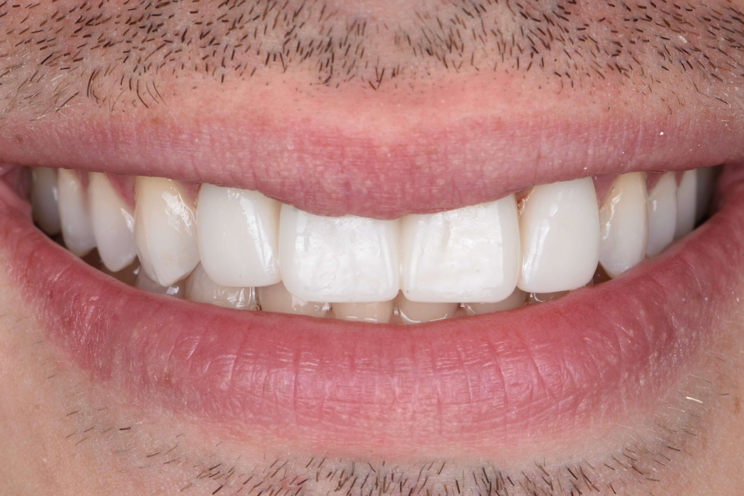 Dental Crowns — after